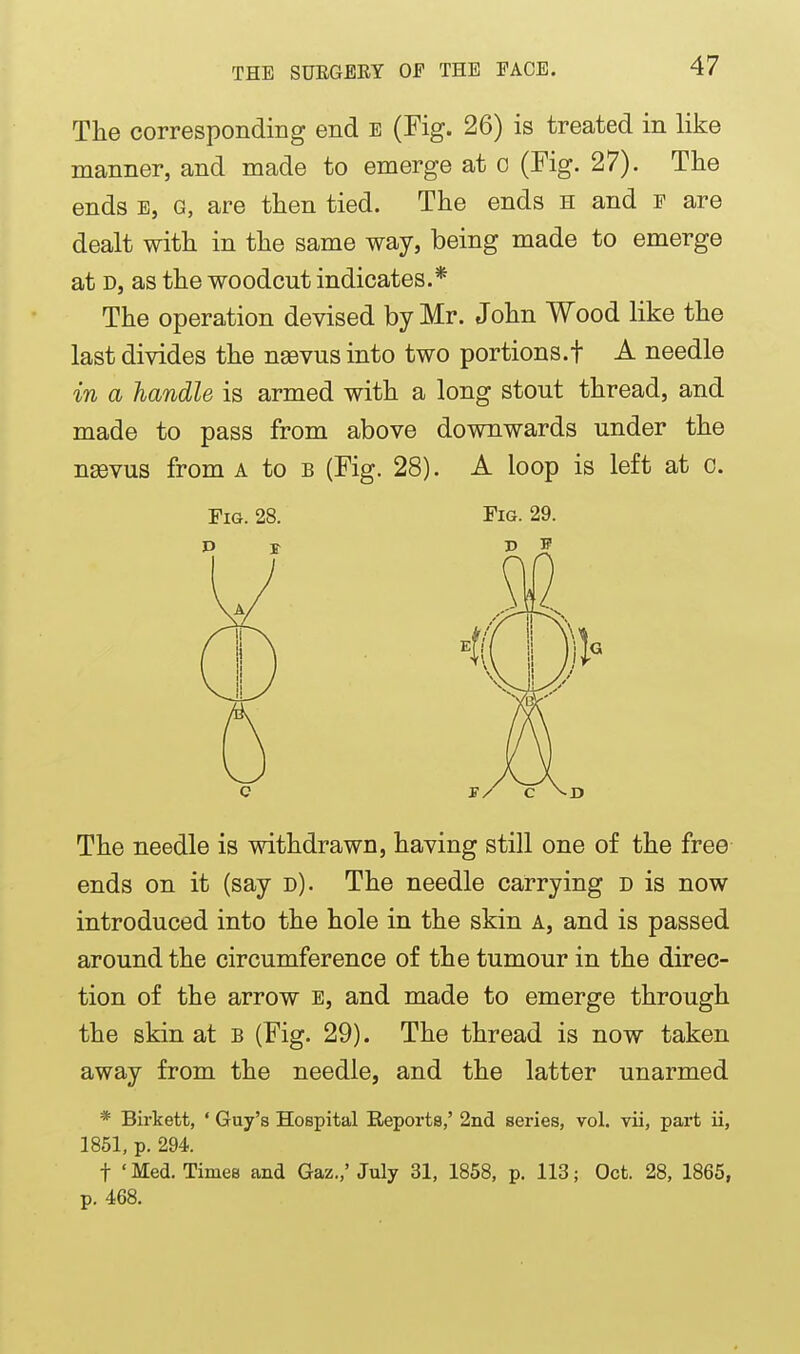 The corresponding end e (Fig. 26) is treated in like manner, and made to emerge at o (Fig. 27). The ends E, G, are then tied. The ends h and f are dealt with in the same way, being made to emerge at D, as the woodcut indicates.* The operation devised by Mr. John Wood like the last divides the naevus into two portions.! A needle in a handle is armed with a long stout thread, and made to pass from above downwards under the nsevus from a to b (Fig. 28). A loop is left at o. Fig. 28. Fig. 29. The needle is withdrawn, having still one of the free ends on it (say d). The needle carrying d is now introduced into the hole in the skin a, and is passed around the circumference of the tumour in the direc- tion of the arrow e, and made to emerge through the skin at B (Fig. 29). The thread is now taken away from the needle, and the latter unarmed * Birkett, ' Guy's Hospital Reports,' 2nd series, vol. vii, part ii, 1861, p. 294. t ' Med. Times and Gaz.,' July 31, 1858, p. 113; Oct. 28, 1865, p. 468.