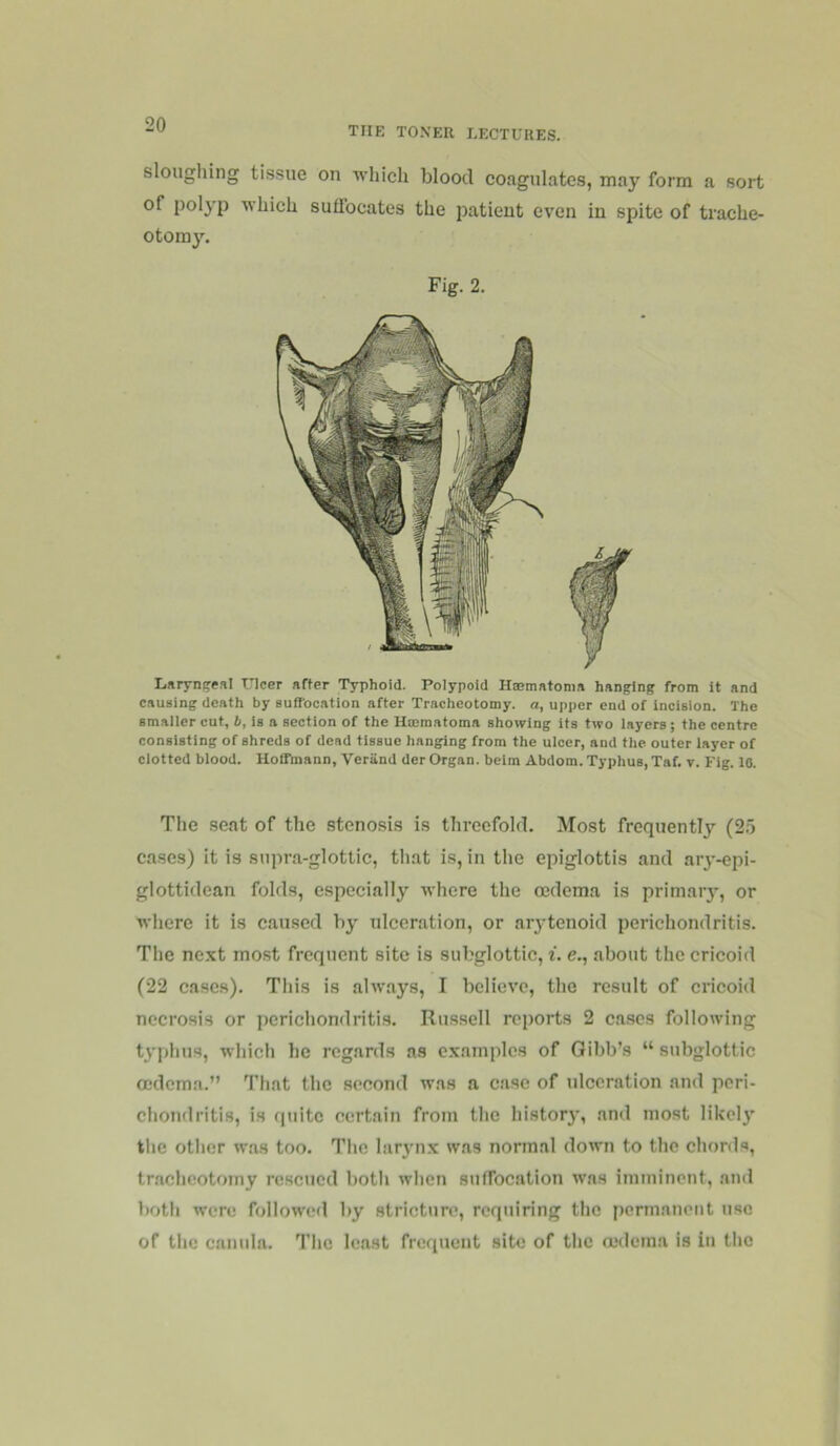 the toner lectures. slougliing tissue on Tvhich blood coagulates, may form a sort of pol}'p ■which suffocates the patient even in spite of trache- otomy. Fig. 2. Lfirym^e.il tUcer after Typhoia. Polypoid Haematonm hanging from it and causing death by suffocation after Tracheotomy, a, upper end of incision. The smaller cut, 6, is a section of the Hcematoma shelving its two layers; the centre consisting of shreds of dead tissue hanging from the ulcer, and the outer layer of clotted blood. Hoffmann, Veriind der Organ, belm Abdom. Typhus, Taf. v. Fig. 10. The seat of the stenosis is threefold. Most frequently (25 cases) it is supra-glottic, tliat is, in the epiglottis and arj'-epi- glottidean folds, especially where the oedema is primary, or where it is caused by ulceration, or arj’tenoid perichondritis. The next most frequent site is subglottic, i. e., about the cricoid (22 cases). This is always, I believe, the result of cricoid necrosis or pcricliondritis. Russell reports 2 cases following t^'phus, which he regards as examples of Gibb’s “ subglottic oedema.” That the second w.as a case of ulceration and peri- chondritis, is fpiitc certain from the histor}', and most likely the other was too. Tlic larj'iix was normal down to the chords, tr.achcotomy rescued botli when suffocation was imminent, and both were followed by stricture, requiring the permanent use of the camila. The least frequent site of the oedema is in the