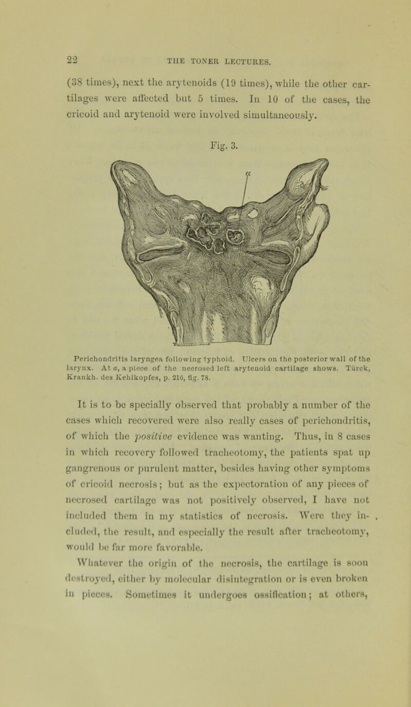 (3S times), next the arytenokls (19 times), while the other car- tilages were afiectod but 5 times. In 10 of the cases, the cricoid and arytenoid were involved simultaneously. Perichondritis laryngea following typhoid. Ulcers on the posterior wall of the larynx. At o, a piece of the necrosed left arytenoid cartilage shows. Tiirck, Kraiikh. des Kehlkopfes, p. 210, flg. 78. It is to be specially observed that probably a number of the cases which recovered were also really cases of perichondritis, of which the positive evidence was wanting. Thus, in 8 cases in which recovery followed tracheotomy, the patients spat up gangrenous or purulent matter, besides having other symptoms of cricoid necrosis; Init as the expectoration of any pieces of necrosed cartilage was not positively ob.servcd, I have not included them in my statistics of necrosis. Were tho3’ in- , eluded, tlie result, and cspeciall}' the result after traclicotonn’, would be far more favorable. Wh.atever the origin of the necrosis, the cartilage is soon dcstro3'e<l, either by molecular disintegration or is even broken in pieces. Sometimes it undergoes ossification; at others.