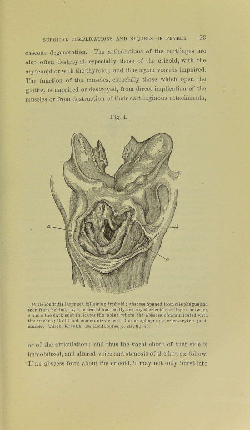ciiseous dcgCDGriitioD. Tlio articulntioiis of tlic cnrtiltigGS rtg also oflGu clGstroyGcl, GspGcially thosG of tliG cricoid, with the arytenoid or with the thyroid ; and thus again voice is impaired. The function of the muscles, especially those which open the glottis, is impaired or destroyed, from direct implication of tlie muscles or from destruction ot their cartilaginous attachments, Fig. 4. Perichondritis Isryngea following typhoid ; abscess opened from (Esophagus and seen from behind, a, b, necrosed and partly destroyed cricoid cartilage ; between a and 6 the dark spot indicates the point where the abscess communicated with the trachea; it did not communicate with the oesophagus; c, crico-aryten. post, muscle. Tiirck, Krankh. des ICehlkopfes, p. 218, flg. 80. or of the articulation; and thus the vocal chord of that side is immobilized, and altered voice and stenosis of tlie larynx follow. If an abscess form about the cricoid, it may not only burst into