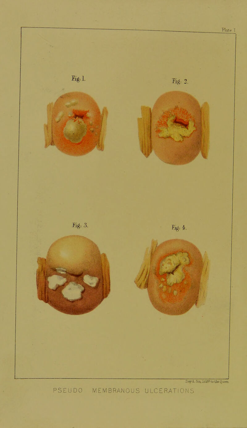 Platp f Day-&. San, to the Queen. PSEUDO MEMBRANOUS ULCERATIONS