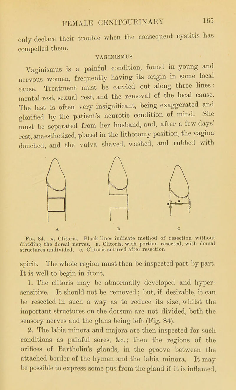 1G5 only declare their trouble when the consequent cystitis has compelled them. VAGINISMUS Vaginismus is a painful condition, found in young and nervous women, frequently having its origin in some local cause. Treatment must be carried out along three lines: mental rest, sexual rest, and the removal of the local cause. The last is often very insignificant, being exaggerated and glorified by the patient’s neurotic condition of mind. She must be separated from her husband, and, after a few days’ rest, anaesthetized, placed in the lithotomy position, the vagina douched, and the vulva shaved, washed, and rubbed with A B C Fig. 84. a. Clitoris. Black lines indicate method of resection without dividing the dorsal nerves, b. Clitoris, with portion resected, with dorsal structures undivided, c. Clitoris sutured after resection spirit. The whole region must then be inspected part by part. It is well to begin in front. 1. The clitoris may be abnormally developed and hyper- sensitive. It should not be removed; but, if desirable, it can be resected in such a way as to reduce its size, whilst the important structures on the dorsum are not divided, both the sensory nerves and the glans being left (Fig. 84). 2. The labia minora and majora are then inspected for such conditions as painful sores, &c.; then the regions of the orifices of Bartholin’s glands, in the groove between the attached border of the hymen and the labia minora. It may be possible to express some pus from the gland if it is inflamed.