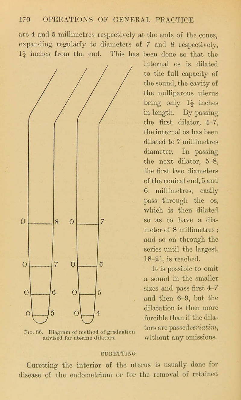 IJ inches from tlie end. are 4 and 5 millimetres respectively at the ends of the cones, expanding regularly to diameters of 7 and 8 respectively, This has been done so that the internal os is dilated to the full capacity of the sound, the cavity of the nulliparous uterus being only 1-| inches in length. By passing the first dilator, 4—7, the internal os has been dilated to 7 millimetres diameter. In passing the next dilator, 5-8, the first two diameters of the conical end, 5 and 6 millimetres, easily pass through the os, which is then dilated so as to have a dia- meter of 8 millimetres ; and so on through the scries until the largest, 18-21, is reached. It is possible to omit a sound in the smaller sizes and pass first 4-7 and then 6-9, but the dilatation is then more forcible than if the dila- „ „„ „ ,, , r , ,. tors are passed seriatim, Fig. 8G. Diagram of method of graduation x m . advised for uterine dilators. without any omissions. CURETTING Curetting the interior of the uterus is usually done for disease of the endometrium or for the removal of retained