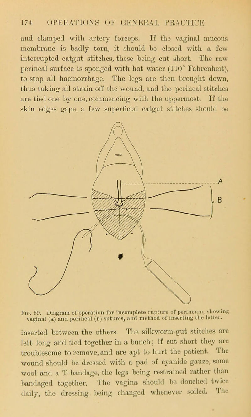 arid clamped with artery forceps. If the vaginal mucous membrane is badly torn, it should be closed with a few interrupted catgut stitches, these being cut short. The raw perineal surface is sponged with hot water (110° Fahrenheit), to stop all haemorrhage. The legs arc then brought down, thus taking all strain off the wound, and the perineal stitches are tied one by one, commencing with the uppermost. If the skin edges gape, a few superficial catgut stitches should be Fio. 89. Diagram of operation for incomplete rupture of perineum, showing vaginal (a) and perineal (b) sutures, and method of inserting the latter. inserted between the others. The silkworm-gut stitches are left long and tied together in a bunch; if cut short they are troublesome to remove, and are apt to hurt the patient, dhe wound should be dressed with a pad of cyanide gauze, some wool and a T-bandage, the legs being restrained rather than bandaged together. The vagina should be douched twice daily, the dressing being changed whenever soiled. The