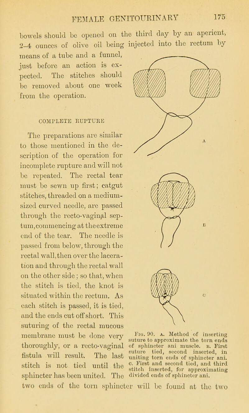 bowels should be opened on the third day by an aperient, 2-4 ounces of olive oil being injected into the rectum by means of a tube and a funnel, just before an action is ex- pected. The stitches should be removed about one week from the operation. COMPLETE RUPTURE The preparations are similar to those mentioned in the de- scription of the operation for incomplete rupture and will not be repeated. The rectal tear must be sewn up first; catgut stitches, threaded on a medium- sized curved needle, are passed through the recto-vaginal sep- tum, commencing at the extreme end of the tear. The needle is passed from below, through the rectal wall,then over the lacera- tion and through the rectal wall on the other side; so that, when the stitch is tied, the knot is situated within the rectum. As each stitch is passed, it is tied, and the ends cut off short. This suturing of the rectal mucous membrane must be done very thoroughly, or a recto-vaginal fistula will result. The last stitch is not tied until the sphincter has been united. The two ends of the torn sphincl Fig. 90. a. Method of inserting suture to approximate the torn ends of sphincter ani muscle, b. First suture tied, second inserted, in uniting torn onds of sphincter ani. c. First and second tied, and third stitch inserted, for approximating divided ends of sphincter ani. cr will be found at the two