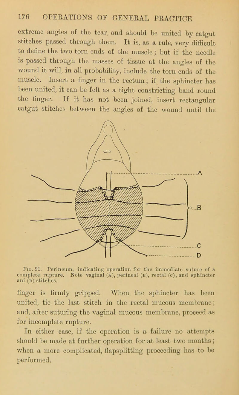 extreme angles of the tear, and should be united by catgut stitches passed through them. It is, as a rule, very difficult to define the two torn ends oi‘ the muscle; but if the needle is passed through the masses of tissue at the angles of the wound it will, in all probability, include the torn ends of the muscle. Insert a finger in the rectum; if the sphincter has been united, it can be felt as a tight constricting band round the finger. If it has not been joined, insert rectangular catgut stitches between the angles of the wound until the Fig. 91. Perineum, indicating operation for the immediate suture of a complete rupture. Note vaginal (a), perineal (b), rectal (c), and sphincter ani (d) stitches. finger is firmly gripped. When the sphincter Inis been united, tic the last stitch in the rectal mucous membrane: and, after suturing the vaginal mucous membrane, proceed as for incomplete rupture. In either case, if the operation is a failure no attempts should be made at further operation for at least two months; when a more complicated, flapsplitting proceeding has to bo performed.