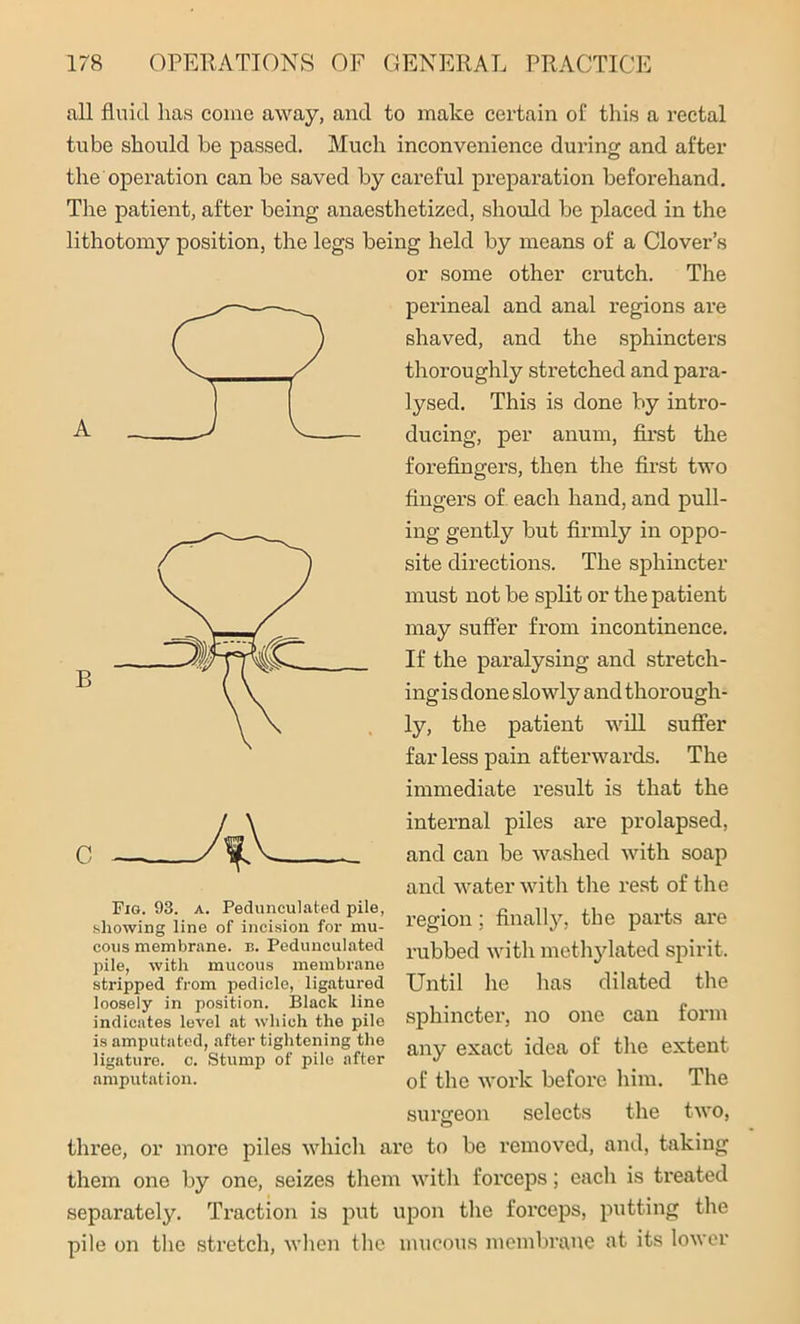 all fluid has come away, and to make certain of this a rectal tube should be passed. Much inconvenience during and after the operation can be saved by careful preparation beforehand. The patient, after being anaesthetized, should be placed in the lithotomy position, the legs being held by means of a Clover’s AV or some other crutch. The perineal and anal regions are shaved, and the sphincters thoroughly stretched and para- lysed. This is done by intro- ducing, per anum, first the forefingers, then the first two fingers of each hand, and pull- ing gently but firmly in oppo- site directions. The sphincter must not be split or the patient may suffer from incontinence. If the paralysing and stretch- ing is done slowly and thorough- ly, the patient will suffer far less pain afterwards. The immediate result is that the internal piles are prolapsed, and can be washed with soap and water with the rest of the Fig. 93. a. Pedunculated pile, showing line of incision for mu- cous membrane, b. Pedunculated pile, with mucous membrane stripped from pedicle, ligatured loosely in position. Black line indicates level at which the pile is amputated, after tightening the ligature, c. Stump of pile after amputation. region ; finally, the parts are rubbed with methylated spirit. Until he has dilated the sphincter, no one can form any exact idea of the extent of the work before him. The surgeon selects the two, three, or more piles which are to be removed, and, taking them one by one, seizes them with forceps; each is treated separately. Traction is put upon the forceps, putting the pile on the stretch, when the mucous membrane at its lower