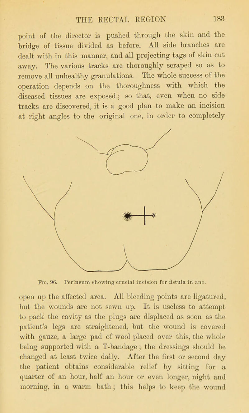 point of the director is pushed through the skin and the bridge of tissue divided as before. All side branches are dealt with in this manner, and all projecting tags of skin cut away. The various tracks are thoroughly scraped so as to remove all unhealthy granulations. The whole success of the operation depends on the thoroughness with which the diseased tissues are exposed; so that, even when no side tracks are discovered, it is a good plan to make an incision at right angles to the original one, in order to completely open up the affected area. All bleeding points are ligatured, but the wounds are not sewn up. It is useless to attempt to pack the cavity as the plugs are displaced as soon as the patient’s legs are straightened, but the wound is covered with gauze, a large pad of wool placed over this, the whole being supported with a T-bandage; the dressings should be changed at least twice daily. After the first or second day the patient obtains considerable relief by sitting for a quarter of an hour, half an hour or even longer, night and morning, in a warm bath ; this helps to keep the wound