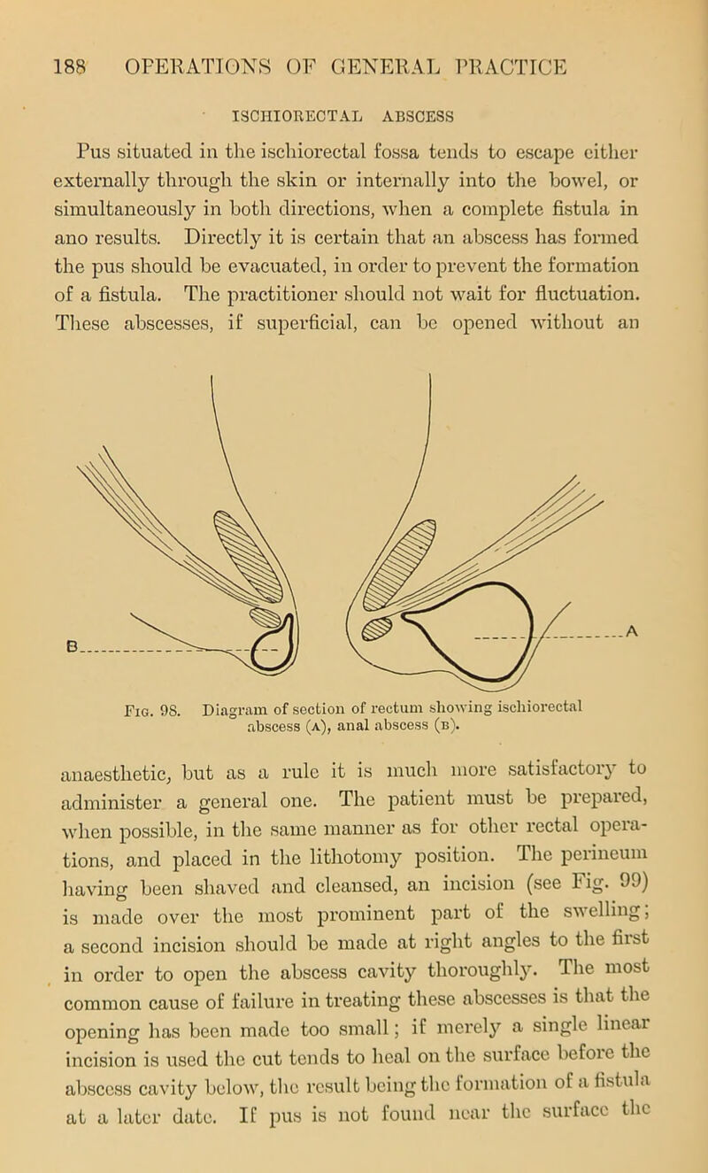 ISCHIORECTAL ABSCESS Pus situated in the ischiorectal fossa tends to escape cither externally through the skin or internally into the bowel, or simultaneously in both directions, when a complete fistula in ano results. Directly it is certain that an abscess has formed the pus should be evacuated, in order to prevent the formation of a fistula. The practitioner should not wait for fluctuation. These abscesses, if superficial, can be opened without an Fig. 98. Diagram of section of rectum showing ischiorectal abscess (a), anal abscess (b). anaesthetic, but as a rule it is much more satisfactory to administer a general one. The patient must be prepared, when possible, in the same manner as for other rectal opeia- tions, and placed in the lithotomy position. The perineum having been shaved and cleansed, an incision (see 1’ ig. 09) is made over the most prominent part of the swelling, a second incision should be made at right angles to the fiist in order to open the abscess cavity thoroughly. The most common cause of failure in treating these abscesses is that the opening has been made too small; if merely a single linear incision is used the cut tends to heal on the surface before the abscess cavity below, the result being the formation of a fistula at a later date. If pus is not found near the surface the