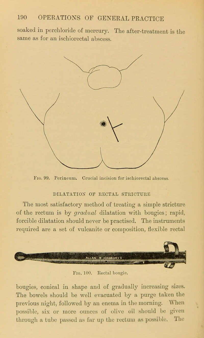 soaked in perchloride of mercury. The after-treatment is the same as for an ischiorectal abscess. DILATATION OF RECTAL STRICTURE The most satisfactory method of treating a simple stricture of the rectum is by gradual dilatation with bougies; rapid, forcible dilatation should never be practised. The instruments required are a set of vulcanite or composition, flexible rectal Fig. 100. Rectal bougie. bougies, conical in shape and of gradually increasing sizes. The bowels should be well evacuated by a purge taken the previous night, followed by an enema in the morning. When possible, six or more ounces of olive oil should be given through a tube passed as far up the rectum jus possible. The