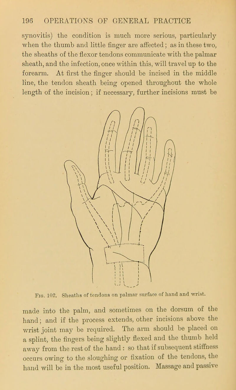 synovitis) the condition is much more serious, particularly when the thumb and little finger are affected; as in these two, the sheaths of the flexor tendons communicate with the palmar sheath, and the infection, once within this, will travel up to the forearm. At first the finger should be incised in the middle line, the tendon sheath being opened throughout the whole length of the incision; if necessary, further incisions must be Fig. 102. Sheaths of tendons on palmar surface of hand and wrist. made into the palm, and sometimes on the dorsum of the hand; and if the process extends, other incisions above the wrist joint may be required. The arm should be placed on a splint, the fingers being slightly flexed and the thumb held away from the rest of the hand : so that i f subsequent stillness occurs owing to the sloughing or fixation of the tendons, the hand will be in the most useful position. Massage and passive