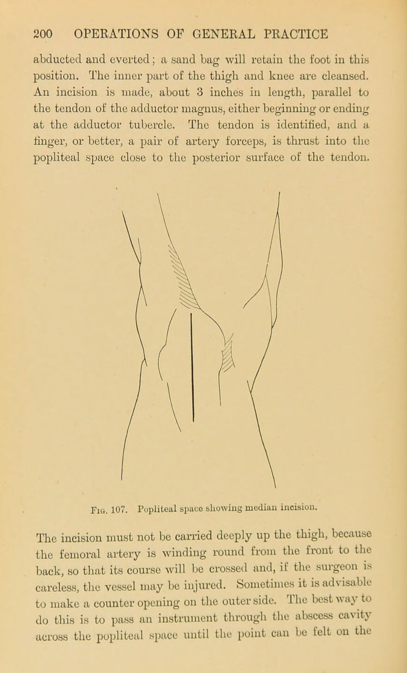 abducted and everted; a sand bag will retain the foot in this position. The inner part of the thigh and knee are cleansed. An incision is made, about 3 inches in length, parallel to the tendon of the adductor magnus, either beginning or ending at the adductor tubercle. The tendon is identified, and a finger, or better, a pair of artery forceps, is thrust into the popliteal space close to the posterior surface of the tendon. Fig. 107. Popliteal space showing median incision. The incision must not be carried deeply up the thigh, because the femoral artery is winding round from the front to the back, so that its course will be crossed and, if the surgeon is careless, the vessel may be injured. Sometimes it is advisable to make a counter opening on the outer side. The best way to do this is to pass an instrument through the abscess cavity across the popliteal space until the point can be felt on the