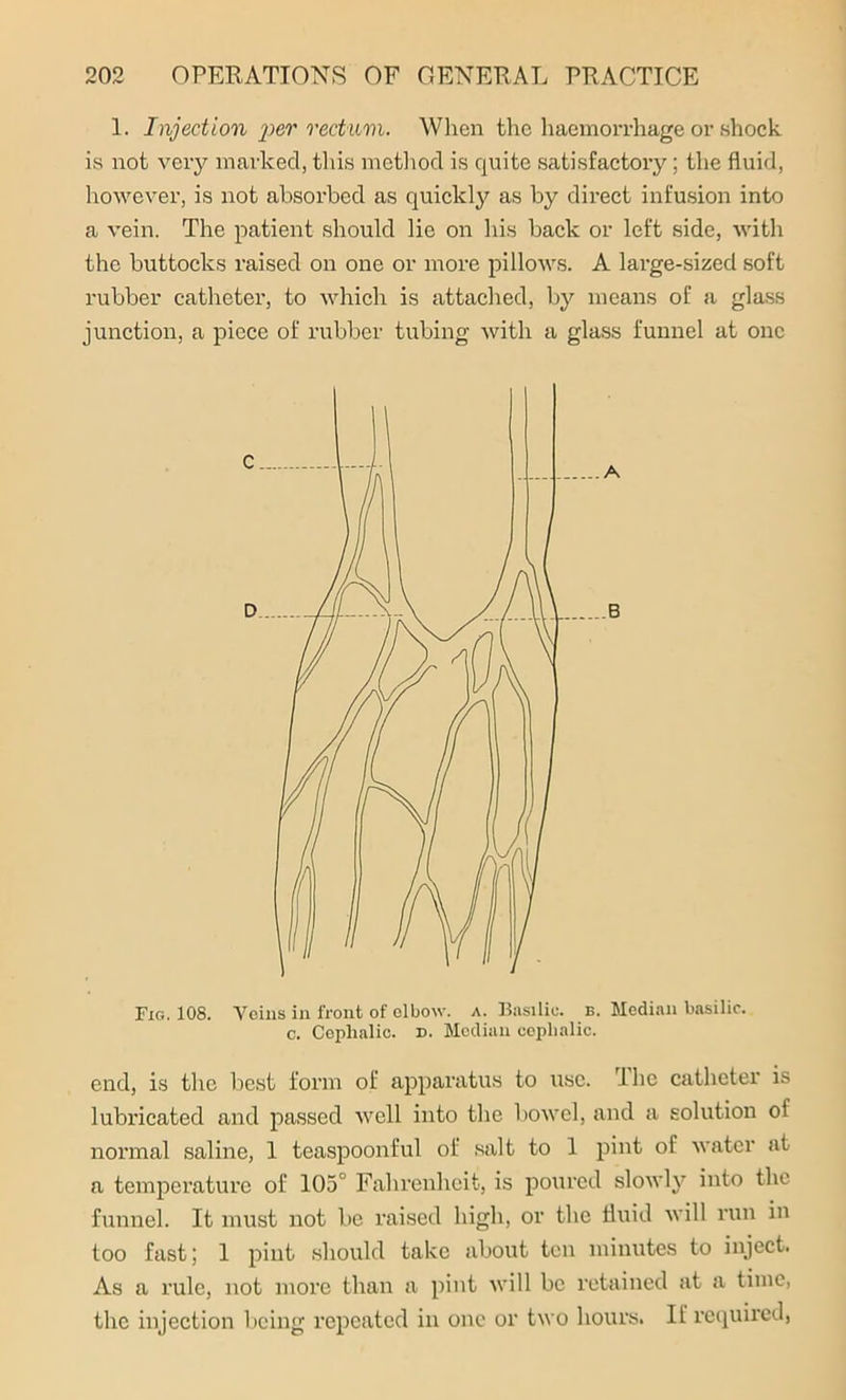 1. Injection 'per rectum. When the haemorrhage or shock is not very marked, this method is quite satisfactory; the fluid, however, is not absorbed as quickly as by direct infusion into a vein. The patient should lie on his back or left side, with the buttocks raised on one or more pillows. A large-sized soft rubber catheter, to which is attached, by means of a glass junction, a piece of rubber tubing with a glass funnel at one Fig. 108. Veins in front of elbow, a. Basilic, b. Median basilic, c. Cephalic, n. Median cephalic. end, is the best form of apparatus to use. The catheter is lubricated and passed well into the bowel, and a solution oi normal saline, 1 teaspoonful of salt to 1 pint of water at a temperature of 105° Fahrenheit, is poured slowly into the funnel. It must not be raised high, or the fluid will run in too fast; 1 pint should take about ton minutes to inject. As a rule, not more than a pint will be retained at a time, the injection being repeated in one or two hours. If required,