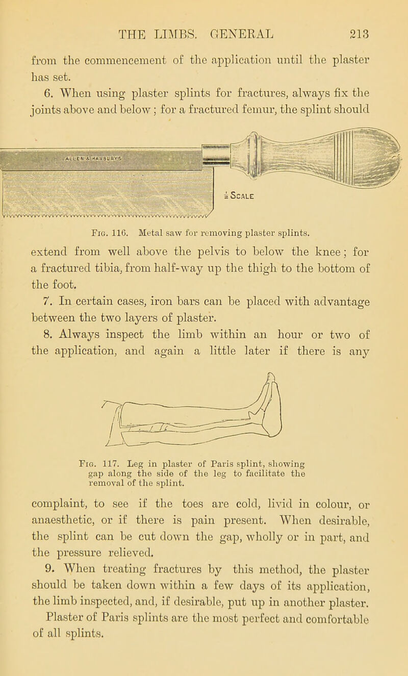 from the commencement of the application until the plaster has set. 6. When using plaster splints for fractures, always fix the joints above and below; for a fractured femur, the splint should Fig. 116. Metal saw for removing plaster splints. extend from well above the pelvis to below the knee; for a fractured tibia, from half-way up the thigh to the bottom of the foot. 7. In certain cases, iron bars can be placed with advantage between the two layers of plaster. 8. Always inspect the limb within an hour or two of the application, and again a little later if there is any Fig. 117. Leg in plaster of Paris splint, showing gap along the side of the leg to facilitate the removal of the splint. complaint, to see if the toes are cold, livid in colour, or anaesthetic, or if there is pain present. When desirable, the splint can be cut down the gap, wholly or in part, and the pressure relieved. 9. When treating fractures by this method, the plaster should be taken down within a few days of its application, the limb inspected, and, if desirable, put up in another plaster. Plaster of Paris splints are the most perfect and comfortable of all splints.