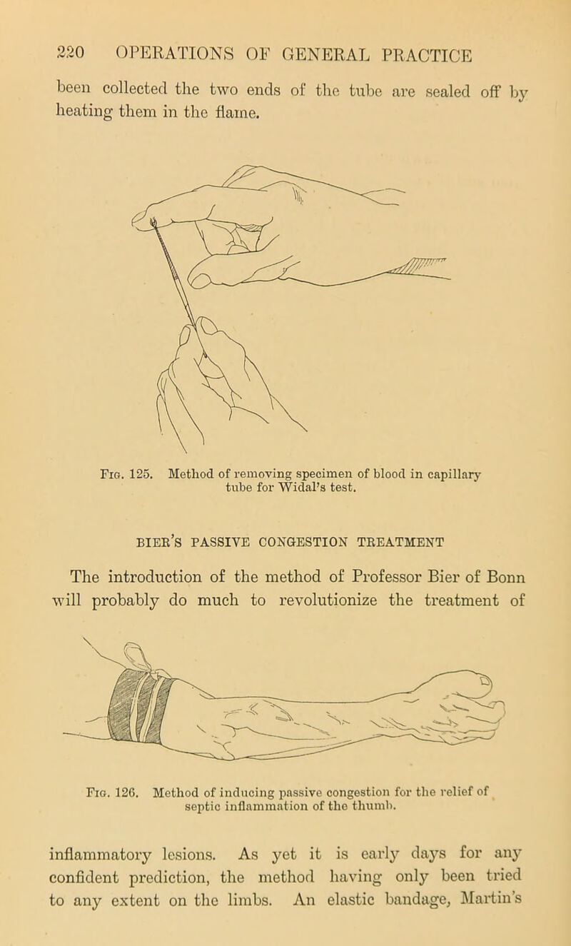 been collected the two ends of the tube are sealed off by heating them in the flame. Fig. 125. Method of removing specimen of blood in capillary tube for Widal’s test. bier’s PASSIVE CONGESTION TREATMENT The introduction of the method of Professor Bier of Bonn will probably do much to revolutionize the treatment of Fig. 126. Method of inducing passive congestion for the relief of septic inflammation of the thumb. inflammatory lesions. As yet it is early days for any confident prediction, the method having only been tried to any extent on the limbs. An elastic bandage, Martin’s