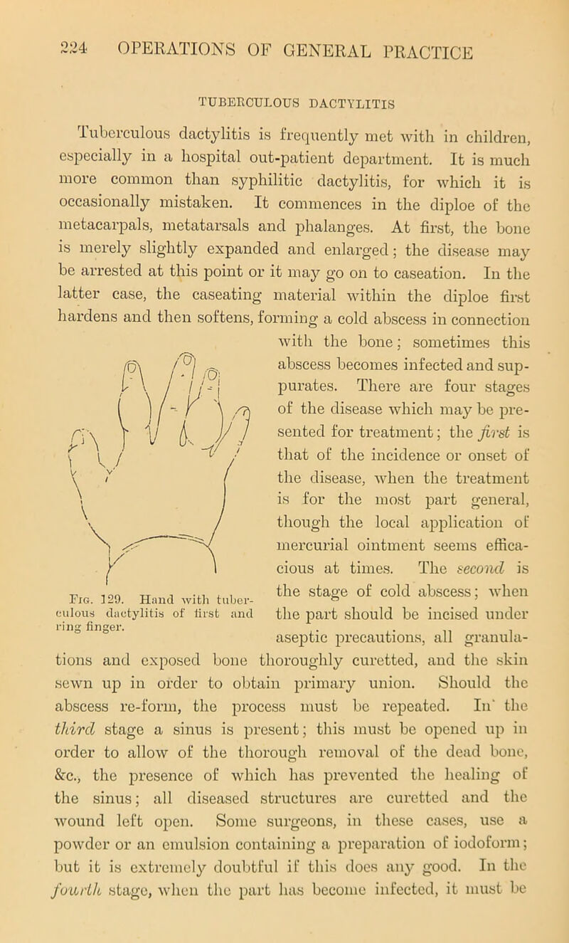 TUBERCULOUS DACTYLITIS Tuberculous dactylitis is frequently met with in children, especially in a hospital out-patient department. It is much more common than syphilitic dactylitis, for which it is occasionally mistaken. It commences in the diploe of the metacarpals, metatarsals and phalanges. At first, the bone is merely slightly expanded and enlarged; the disease may be arrested at this point or it may go on to caseation. In the latter case, the caseating material within the diploe first hardens and then softens, forming a cold abscess in connection with the bone; sometimes this abscess becomes infected and sup- purates. There are four stages of the disease which may be pre- sented for treatment; the first is that of the incidence or onset of the disease, when the treatment is for the most part general, though the local application of mercurial ointment seems effica- cious at times. The second is the stage of cold abscess; when the part should be incised under asejitic precautions, all granula- tions and exposed bone thoroughly curetted, and the skin sewn up in order to obtain primary union. Should the abscess re-form, the process must be repeated. In' the third stage a sinus is present; this must be opened up in order to allow of the thorough removal of the dead bone, &c., the presence of which has prevented the healing of the sinus; all diseased structures are curetted and the wound left open. Some surgeons, in these cases, use a powder or an emulsion containing a preparation of iodoform; but it is extremely doubtful if this does any good. In the fourth stage, when the part has become infected, it must be culous dactylitis of first and ring finger.