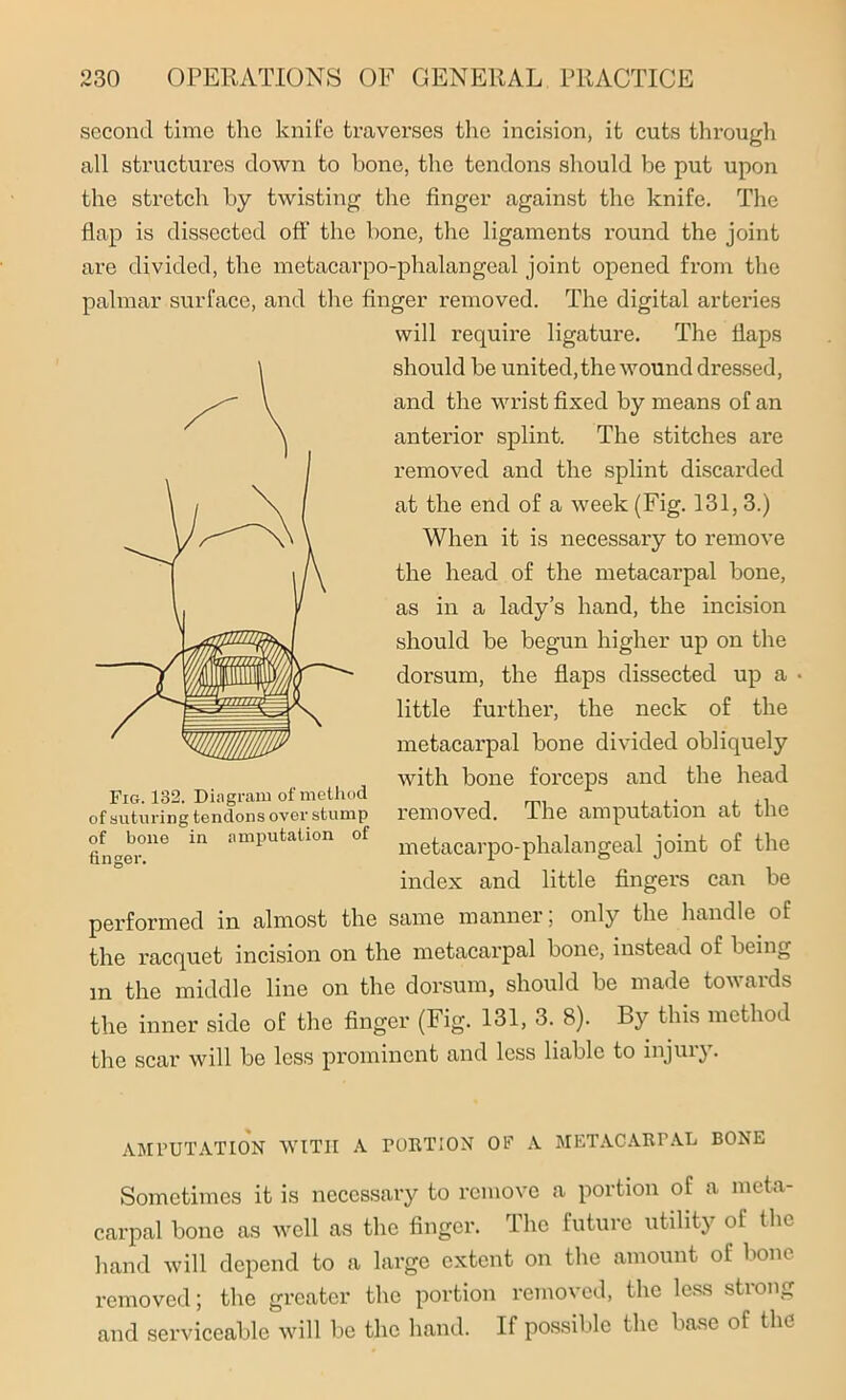 second time the knife traverses the incision, it cuts through all structures clown to bone, the tendons should be put upon the stretch by twisting the finger against the knife. The flap is dissected ofi' the bone, the ligaments round the joint are divided, the metacarpo-phalangeal joint opened from the palmar surface, and the finger removed. The digital arteries will require ligature. The flaps should be united, the wound dressed, and the wrist fixed by means of an anterior splint. The stitches are removed and the splint discarded at the end of a week (Fig. 131, 3.) When it is necessary to remove the head of the metacarpal bone, as in a lady’s hand, the incision should be begun higher up on the dorsum, the flaps dissected up a little further, the neck of the metacarpal bone divided obliquely with bone forceps and the head Fig. 132. Diagram of method ... , of suturing tendons over stump removed, the amputation at the finder.116 “ mputation °f metacarpo-phalangeal joint of the index and little fingers can be performed in almost the same manner, only the handle of the racquet incision on the metacarpal bone, instead of being m the middle line on the dorsum, should be made towards the inner side of the finger (Fig. 131, 3. 8). By this method the scar will be less prominent and less liable to injuij. AMPUTATION WITH A FORTION OP A METACARPAL BONE Sometimes it is necessary to remove a portion of a meta- carpal bone as well as the finger. The future utility of the hand will depend to a large extent on the amount of bone removed; the greater the portion removed, the less strong and serviceable will be the hand. If possible the base of the