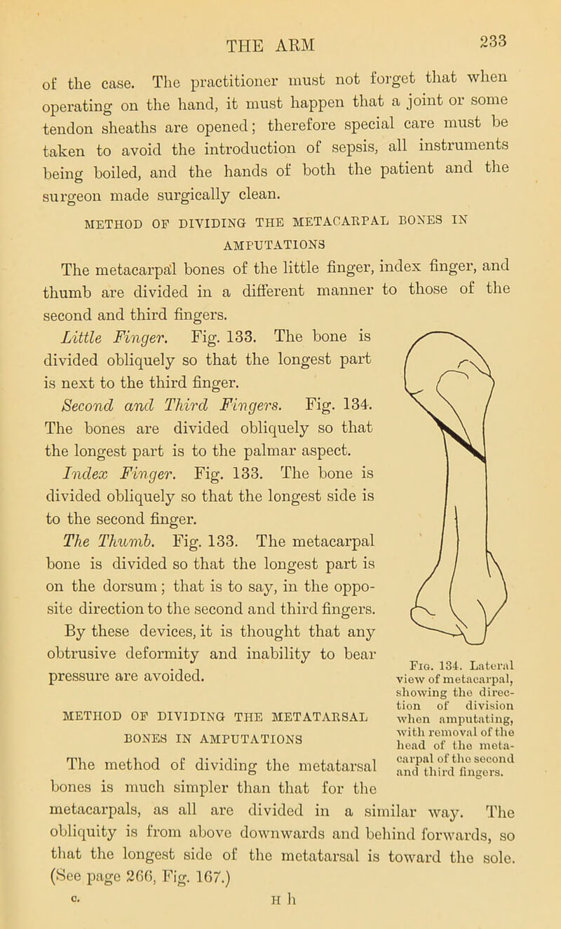 of the case. The practitioner must not forget that when operating on the hand, it must happen that a joint or some tendon sheaths are opened; therefore special caie must be taken to avoid the introduction of sepsis, all instruments being boiled, and the hands of both the patient and the surgeon made surgically clean. METHOD OP DIVIDING THE METACARPAL BONES IN AMPUTATIONS The metacarpal bones of the little finger, index finger, and thumb are divided in a different manner to those of the second and third fingers. Little Finger. Fig. 133. The bone is divided obliquely so that the longest part is next to the third finger. Second and Third Fingers. Fig. 134. The bones are divided obliquely so that the longest part is to the palmar aspect. Index Finger. Fig. 133. The bone is divided obliquely so that the longest side is to the second finger. The Thumb. Fig. 133. The metacarpal bone is divided so that the longest part is on the dorsum; that is to say, in the oppo- site direction to the second and third fingers. By these devices, it is thought that any obtrusive deformity and inability to bear pressure are avoided. METHOD OP DIVIDING THE METATARSAL BONES IN AMPUTATIONS The method of dividing the metatarsal bones is much simpler than that for the metacarpals, as all are divided in a similar way. The obliquity is from above downwards and behind forwards, so that the longest side of the metatarsal is toward the sole. (See page 266, Fig. 167.) Pig. 134. Lateral view of metacarpal, showing the direc- tion of division when amputating, with removal of the head of the meta- carpal of the second and third fingers.