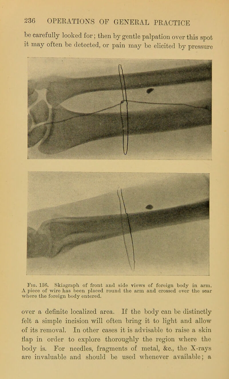 be carefully looked for; then by gentle palpation over this spot it may often be detected, or pain may be elicited by pressure Fig. 136. Skiagraph of front and side views of foreign body in arm. A piece of wire has been placed round tlio arm and crossed over the soar where the foreign body entered. over a definite localized area. If the body can be distinctly felt a simple incision will often bring it to light and allow of its removal. In other cases it is advisable to raise a skin flap in order to explore thoroughly the region where the body is. For needles, fragments of metal, &c., the X-rays are invaluable and should be used whenever available; a