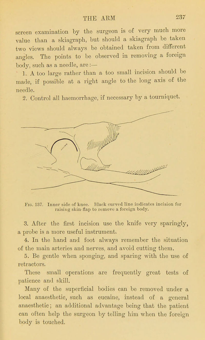 screen examination by the surgeon is of very much more value than a skiagraph, but should a skiagraph be taken two views should always be obtained taken from diffeient angles. The points to be observed in removing a foreign body, such as a needle, arc:— ]. A too large rather than a too small incision should be made, if possible at a right angle to the long axis of the needle. 2. Control all haemorrhage, if necessary by a tourniquet. Fig. 137. Inner side of knee. Black curved line indicates incision for raising skin-flap to remove a foreign body. 3. After the first incision use the knife very sparingly, a probe is a more useful instrument. 4. In the hand and foot always remember the situation of the main arteries and nerves, and avoid cutting them. 5. Be gentle when sponging, and sparing with the use of retractors. These small operations are frequently great tests of patience and skill. Many of the superficial bodies can be removed under a local anaesthetic, such as eucainc, instead of a general anaesthetic; an additional advantage being that the patient can often help the surgeon by telling him when the foreign body is touched.