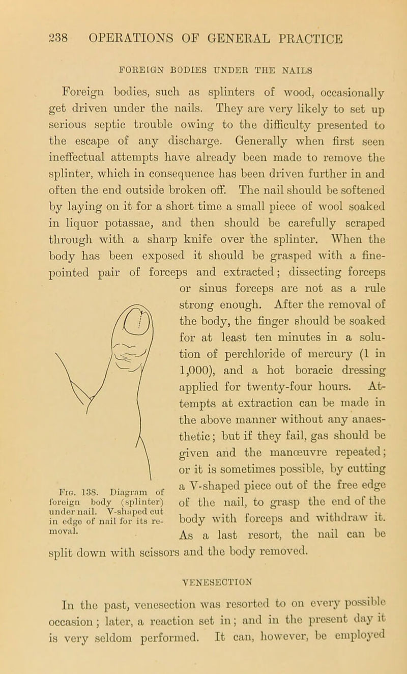 FOREIGN BODIES UNDER THE NAILS Foreign bodies, such as splinters of wood, occasionally get driven under the nails. They are very likely to set up serious septic trouble owing to the difficulty presented to the escape of any discharge. Generally when first seen ineffectual attempts have already been made to remove the splinter, which in consequence has been driven further in and often the end outside broken off. The nail should be softened by laying on it for a short time a small piece of wool soaked in liquor potassae, and then should be carefully scraped through with a sharp knife over the splinter. When the body has been exposed it should be grasped with a fine- pointed pair of forceps and extracted; dissecting forceps or sinus forceps are not as a rule strong enough. After the removal of the body, the finger should be soaked for at least ten minutes in a solu- tion of perchloride of mercury (1 in 1,000), and a hot boracic dressing applied for twenty-four hours. At- tempts at extraction can be made in the above manner without any anaes- thetic ; but if they fail, gas should be given and the manoeuvre repeated; or it is sometimes possible, by cutting a Y-shaped piece out of the free edge of the nail, to grasp the end of the body with forceps and withdraw it. As a last resort, the nail can be split down with scissors and the body removed. VENESECTION In the past, venesection was resorted to on every possible occasion; later, a reaction set in; and in the present day it is very seldom performed. It can, however, be employed foreign body (splinter) under nail. V-shaped cut in edge of nail for its re- moval.