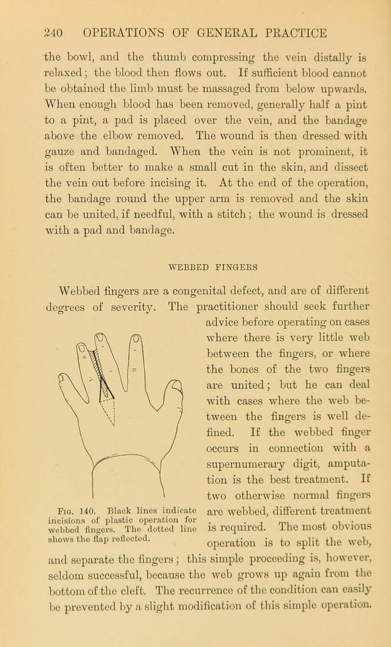 the bowl, and the thumb compressing the vein distally is relaxed; the blood then flows out. If sufficient blood cannot be obtained the limb must be massaged from below upwards. When enough blood has been removed, genei’ally half a pint to a pint, a pad is placed over the vein, and the bandage above the elbow removed. The wound is then dressed with gauze and bandaged. When the vein is not prominent, it is often better to make a small cut in the skin, and dissect the vein out before incising it. At the end of the operation, the bandage round the upper arm is removed and the skin can be united, if needful, with a stitch; the wound is dressed with a pad and bandage. WEBBED FINGERS Webbed fingers are a congenital defect, and are of different degrees of severity. The practitioner should seek further advice before operating on cases where there is very little web between the fingers, or where the bones of the two fingers are united; but he can deal with cases where the web be- tween the fingers is well de- fined. If the webbed finger occurs in connection with a supernumerary digit, amputa- tion is the best treatment. If two otherwise normal fingers Fig. uo. Black lines indicate are webbed, different treatment incisions of plastic operation for . . . ml , , . webbed fingers. The dotted line IS required. I he most ObVIOUS shows the flap reflected. operation is to split the web, and separate the fingers ; this simple proceeding is, however, seldom successful, because the web grows up again from the bottom of the cleft. The recurrence of the condition can easily be prevented by a slight modification of this simple operation.