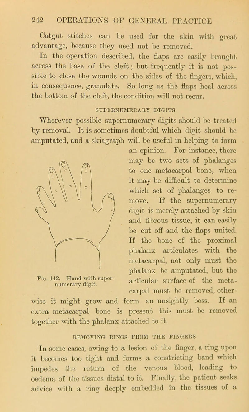 Catgut stitches can be used for the skin with great advantage, because they need not be removed. In the operation described, the flaps are easily brought across the base of the cleft; but frequently it is not pos- sible to close the wounds on the sides of the fingers, which, in consequence, granulate. So long as the flaps heal across the bottom of the cleft, the condition will not recur. SUPERNUMERARY DIGITS Wherever possible supernumerary digits should be treated by removal. It is sometimes doubtful which digit should be amputated, and a skiagraph will be useful in helping to form an opinion. For instance, there may be two sets of phalanges to one metacarpal bone, when it may be difficult to determine which set of phalanges to re- move. If the supernumerary digit is merely attached by skin and fibrous tissue, it can easily be cut off and the flaps united. If the bone of the proximal phalanx articulates with the metacarpal, not only must the phalanx be amputated, but the articular surface of the meta- carpal must be removed, other- mn an unsightly boss. If an extra metacarpal bone is present this must be removed together with the phalanx attached to it. REMOVING RINGS FROM THE FINGERS In some cases, owing to a lesion of the finger, a ring upon it becomes too tight and forms a constricting band which impedes the return of the venous blood, leading to oedema of the tissues distal to it. Finally, the patient seeks advice with a ring deeply embedded in the tissues of a Fig. 142. Hand with super- numerary digit. wise it might grow and