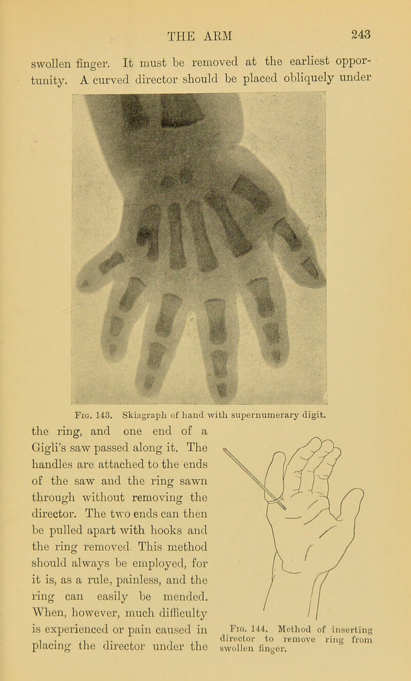 swollen finger. It must be removed at the eai’liest oppor- tunity. A curved director should be placed obliquely under Fig. 143. Skiagraph of hand with supernumerary digit. the ring, and one end of a Gigli’s saw passed along it. The handles are attached to the ends of the saw and the ring sawn through without removing the director. The two ends can then be pulled apart with hooks and the ring removed This method should always be employed, for it is, as a rule, painless, and the ring can easily be mended. When, however, much difficulty is experienced or pain caused in placing the director under the Fig. 144. Method of inserting director to remove ring from swollen finger.