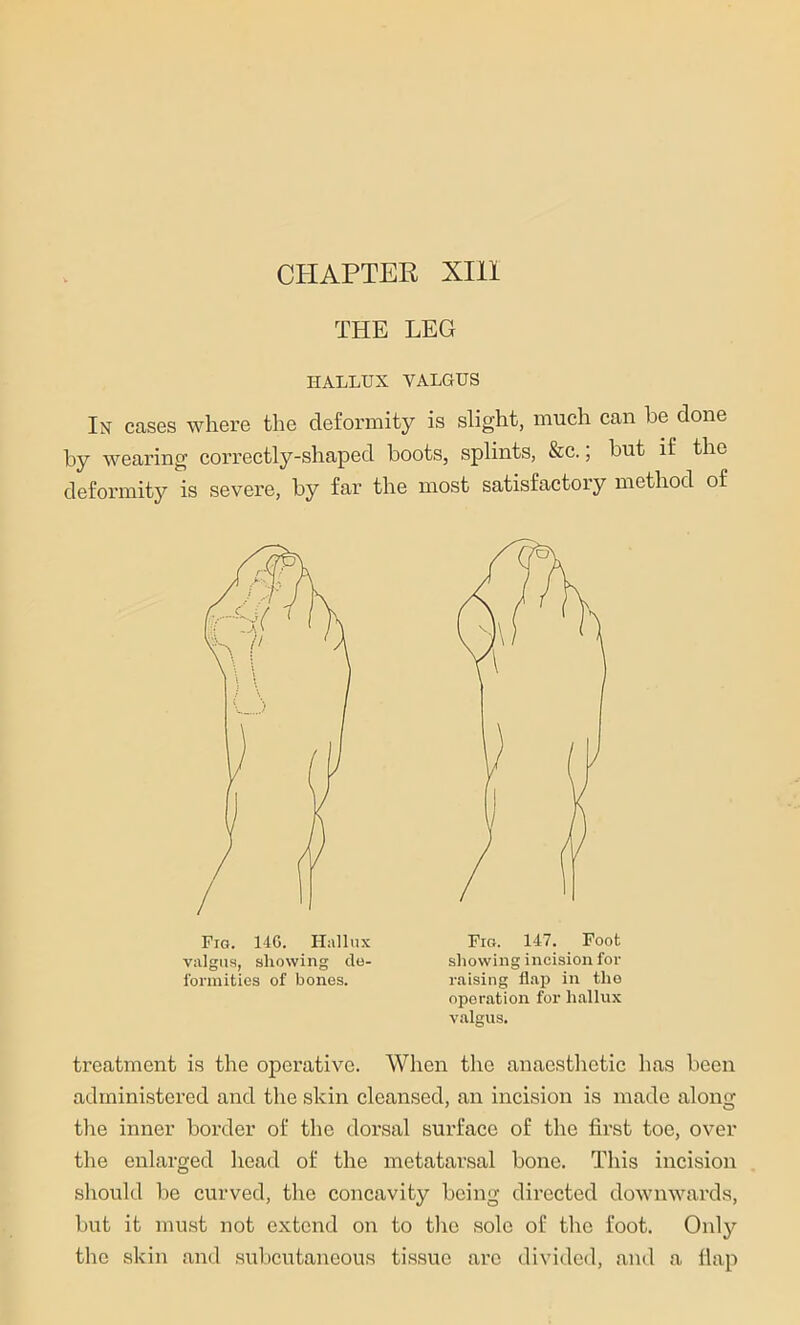 CHAPTER XIII THE LEG HALLUX YALGUS In cases where the deformity is slight, much can be done by wearing correctly-shaped boots, splints, &c.; but if the deformity is severe, by far the most satisfactory method of valgus, showing de- formities of bones. Fig. 147. Foot showing incision for raising flap in the operation for hallux valgus. treatment is the operative. When the anaesthetic has been administered and the skin cleansed, an incision is made along the inner border of the dorsal surface of the first toe, over the enlarged head of the metatarsal bone. This incision should be curved, the concavity being directed downwards, but it must not extend on to the sole of the foot. Only the skin and subcutaneous tissue arc divided, and a flap