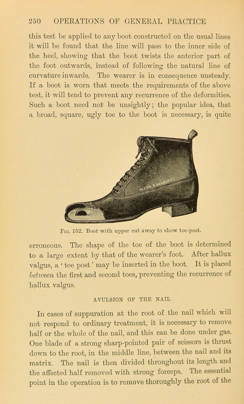 this test be applied to any boot constructed on the usual lines it will be found that the line will pass to the inner side of the heel, showing that the boot twists the anterior part of the foot outwards, instead of following the natural line of curvature inwards. The wearer is in consequence unsteady. If a boot is worn that meets the requirements of the above test, it will tend to prevent any recurrence of the deformities. Such a boot need not be unsightly; the popular idea, that a broad, square, ugly toe to the boot is necessary, is quite Fig. 152. Boot with upper cut away to show toe-post. erroneous. The shape of the toe of the boot is determined to a large extent by that of the wearer’s foot. After hallux valgus, a ‘ toe post ’ may be inserted in the boot. It is placed between the first and second toes, preventing the recurrence of hallux valgus. AVULSION OF THE NAIL In cases of suppuration at the root of the nail which will not respond to ordinary treatment, it is necessary to remove half or the whole of the nail, and this can be done under gas. One blade of a strong sharp-pointed pair of scissors is thrust down to the root, in the middle line, between the nail and its matrix. The nail is then divided throughout its length and the affected half removed with strong forceps. rIhe essential point in the operation is to remove thoroughly the root of the