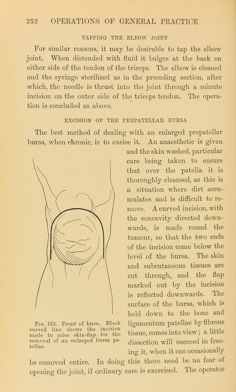 TAPPING THE ELBOW JOINT For similar reasons, it may be desirable to tap the elbow joint. When distended with fluid it bulges at the back on either side of the tendon of the triceps. The elbow is cleaned and the syringe sterilized as in the preceding section, after which, the needle is thrust into the joint through a minute incision on the outer side of the triceps tendon. The opera- tion is concluded as above. EXCISION OF THE PKEPATELLAR BURSA The best method of dealing with an enlarged prepatellar bursa, when chronic, is to excise it. An anaesthetic is given removal of an enlarged bursa pa- tellae. bo removed entire. In doing opening the joint, if ordinary < and the skin washed, particular care being taken to ensure that over the patella it is thoroughly cleansed, as this is a situation where dirt accu- mulates and is difficult to re- move. A curved incision, with the concavity directed down- wards, is made round the tumour, so that the two ends of the incision come below the level of the bursa. The skin and subcutaneous tissues are cut through, and the flap marked out by the incision is reflected downwards. The surface of the bursa, which is held down to the bone and ligamentum patellae by fibrous tissue, comes into view; a little dissection will succeed in free- ing; it, when it can occasionally this there need be no fear of :arc is exercised. The operator