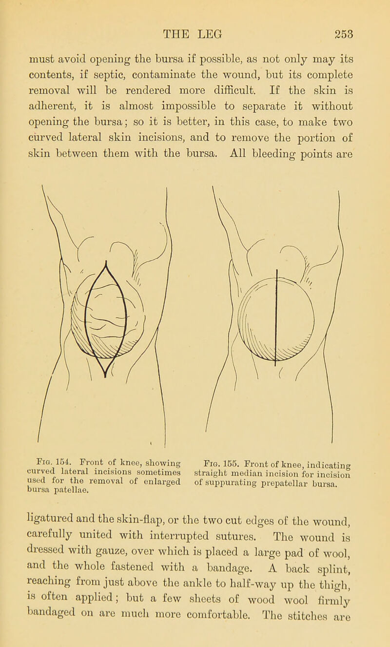 must avoid opening the bursa if possible, as not only may its contents, if septic, contaminate the wound, but its complete removal will be rendered more difficult. If the skin is adherent, it is almost impossible to separate it without opening the bursa; so it is better, in this case, to make two curved lateral skin incisions, and to remove the portion of skin between them with the bursa. All bleeding points are Fig. 154. Front of knee, showing Fig. 155. Front of knee, indicating curved lateral incisions sometimes straight median incision for incision used for the removal of enlarged of suppurating prepatellar bursa bursa patellae. ligatured and the skin-flap, or the two cut edges of the wound, carefully united with interrupted sutures. The wound is dressed with gauze, over which is placed a large pad of wool, and the whole fastened with a bandage. A back splint, leaching from just above the ankle to half-way up the thigh, is often applied; but a few sheets of wood wool firmly bandaged on are much more comfortable. The stitches are