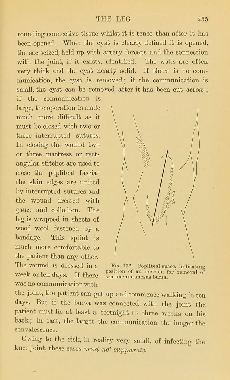 rounding connective tissue whilst it is tense than after it has been opened. When the cyst is clearly defined it is opened, the sac seized, held up with artery forceps and the connection with the joint, if it exists, identified. The walls are often very thick and the cyst nearly solid. If there is no com- munication, the cyst is removed ; if the communication is small, the cyst can be removed after it has been cut across; if the communication is large, the operation is made much more difficult as it must be closed with two or three interrupted sutures. In closing the wound two or three mattress or rect- angular stitches are used to close the popliteal fascia; the skin edges are united by interrupted sutures and the wound dressed with gauze and collodion. The leg is wrapped in sheets of wood wool fastened by a bandage. This splint is much more comfortable to the patient than any other. The wound is dressed in a week or ten days. If there was no communication with the joint, the patient can get up and commence walking in ten days. But if the bursa was connected with the joint the patient must lie at least a fortnight to three weeks on his back; in fact, the larger the communication the longer the convalescence. Fig. 156. Popliteal space, indicating position of an incision for removal of semimembranosus bursa. Owing to the risk, in reality very small, of infecting the knee joint, these cases must not suppurate.