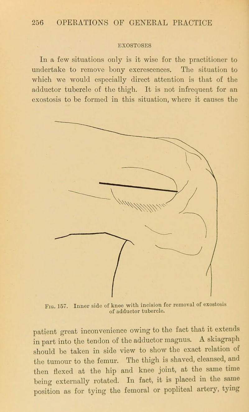 EXOSTOSES In a few situations only is it wise for the practitioner to undertake to remove bony excrescences. The situation to which we would especially direct attention is that of the adductor tubercle of the thigh. It is not infrequent for an exostosis to be formed in this situation, where it causes the Fig. 157. Inner side of knee with incision for removal of exostosis of adductor tubercle. patient great inconvenience owing to the fact that it extends in part into the tendon of the adductor magnus. A skiagraph should be taken in side view to show the exact relation of the tumour to the femur. The thigh is shaved, cleansed, and then flexed at the hip and knee joint, at the same time being externally rotated. In fact, it is placed in the same position as for tying the femoral or popliteal artery, tying