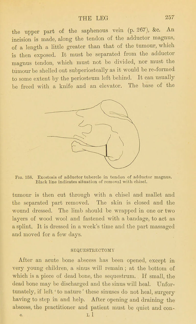 the upper part of the saphenous vein (p. 267), &c. An incision is made, along the tendon of the adductor magnus, of a length a little greater than that of the tumour, which is then exposed. It must be separated from the adductoi magnus tendon, which must not be divided, nor must the tumour be shelled out subperiosteally as it would be re-formed to some extent by the periosteum left behind. It can usually be freed with a knife and an elevator. The base of the Fig. 158. Exostosis of adductor tubercle in tendon of adductor magnus. Black line indicates situation of removal with chisel. tumour is then cut through with a chisel and mallet and the separated part removed. The skin is closed and the wound dressed. The limb should be wrapped in one or two layers of wood wool and fastened with a bandage, to act as a splint. It is dressed in a week’s time and the part massaged and moved for a few days. SEQUESTRECTOMY After an acute bone abscess has been opened, except in very young children, a sinus will remain ; at the bottom of which is a piece of dead bone, the sequestrum. If small, the dead bone may be discharged and the sinus will heal. Unfor- tunately, if left ‘ to nature ’ these sinuses do not heal, surgery having to step in and help. After opening and draining the abscess, the practitioner and patient must be quiet and con- c. L 1