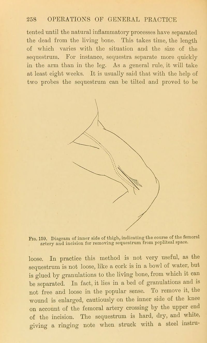 tented until the natural inflammatory processes have separated the dead from the living bone. This takes time, the length of which varies with the situation and the size of the sequestrum. For instance, sequestra separate more quickly in the arm than in the leg. As a general rule, it will take at least eight weeks. It is usually said that with the help of two probes the sequestrum can be tilted and proved to be Fig. 159. Diagram of inner side of thigh, indicating the course of the femoral artery and incision for removing sequestrum from popliteal space. loose. In practice this method is not very useful, as the sequestrum is not loose, like a cork is in a bowl of water, but is glued by granulations to the living bone, from which it can be separated. In fact, it lies in a bed of granulations and is not free and loose in the popular sense. To remove it, the wound is enlarged, cautiously on the inner side of the knee on account of the femoral artery crossing by the upper end of the incision. The sequestrum is hard, dry, and w hite, giving a ringing note when struck with a steel instiu-