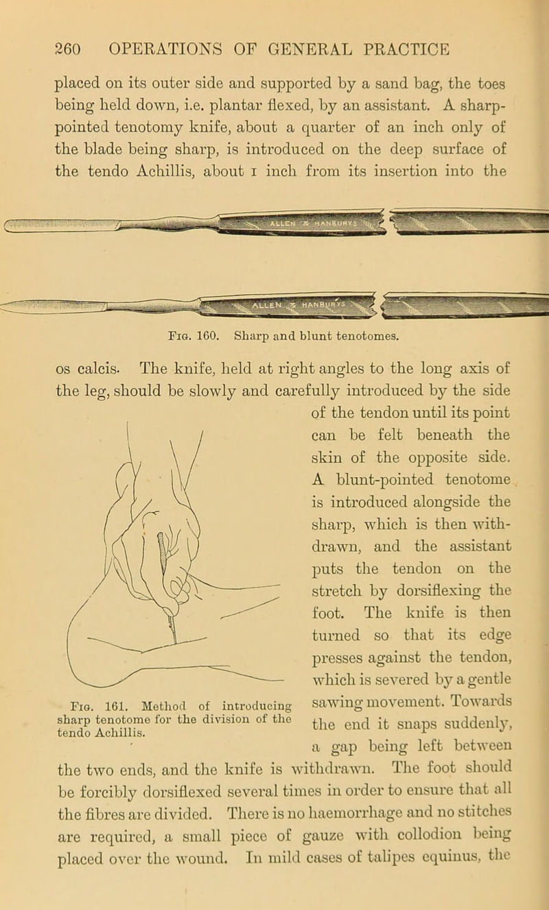 placed on its outer side and supported by a sand bag, the toes being held down, i.e. plantar flexed, by an assistant. A sharp- pointed tenotomy knife, about a quarter of an inch only of the blade being sharp, is introduced on the deep surface of the tendo Achillis, about I inch from its insertion into the Fig. 160. Sharp and blunt tenotomes. os calcis. The knife, held at right angles to the long axis of the leg, should be slowly and carefully introduced by the side of the tendon until its point can be felt beneath the skin of the opposite side. A blunt-pointed tenotome is introduced alongside the sharp, which is then with- drawn, and the assistant puts the tendon on the stretch by dorsiflexing the foot. The knife is then turned so that its edge presses against the tendon, which is severed by a gentle sawing movement. Towards the end it snaps suddenly, a gap being left between the two ends, and the knife is withdrawn. The foot should be forcibly dorsiflexed several times in order to ensure that all the fibres are divided. There is no haemorrhage and no stitches are required, a small piece of gauze with collodion being placed over the wound. In mild cases of talipes equinus, the Fig. 161. Method of introducing sharp tenotome for the division of the tendo Achillis.