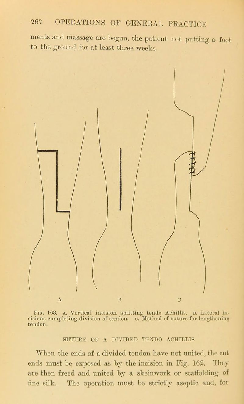 merits and massage are begun, the patient not putting a foot to the ground for at least three weeks. Fig. 163. a. Vertical incision splitting tendo Acliillis. b. Lateral in- cisions completing division of tendon, c. Method of suture for lengthening tendon. SUTURE OF A DIVIDED TENDO ACHILLIS When the ends of a divided tendon have not united, the cut ends must be exposed as by the incision in Fig. 162. They are then freed and united by a skeinworlc or scaffolding of fine silk. The operation must be strictly aseptic and, for