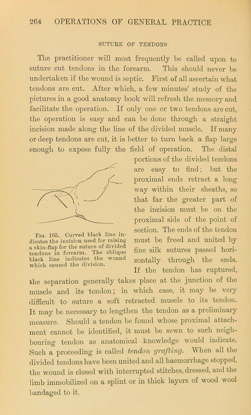 SUTURE OP TENDONS The practitioner will most frequently be called upon to suture cut tendons in the forearm. This should never be undertaken if the wound is septic. First of all ascertain what tendons are cut. After which, a few minutes’ study of the pictures in a good anatomy book will refresh the memory and facilitate the operation. If only one or two tendons are cut, the operation is easy and can be done through a straight incision made along the line of the divided muscle. If many or deep tendons are cut, it is better to turn back a flap large enough to expose fully the field of operation. The distal Fig. 165. Curved black line in- ' , . dicates the incision used for raising must be treed and united by black line indicates the wound zontally through the ends, which caused the division. , , , the separation generally takes place at the junction of the muscle and its tendon; in which case, it may be very difficult to suture a soft retracted muscle to its tendon. It may be necessary to lengthen the tendon as a preliminary measure. Should a tendon be found whose proximal attach- ment cannot be identified, it must be sewn to such neigh- bouring tendon as anatomical knowledge would indicate. Such a proceeding is called tendon grafting. When all the divided tendons have been united and all haemorrhage stopped, the wound is closed with interrupted stitches, dressed, and the limb immobilized on a splint or in thick layers of wood wool bandaged to it. portions of the divided tendons are easy to find; but the proximal ends retract a long way within their sheaths, so that far the greater part of the incision must be on the proximal side of the point of section. The ends of the tendon If the tendon has ruptured,