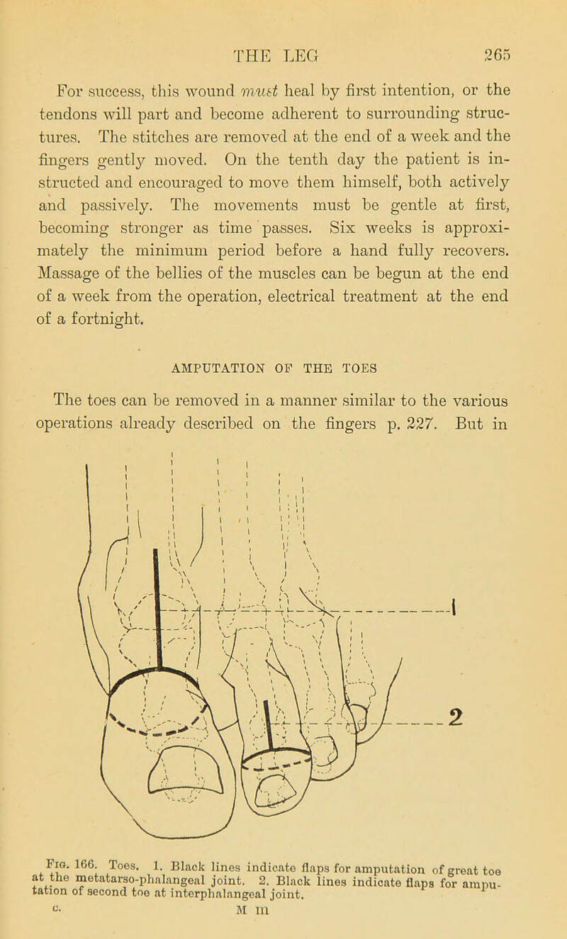 For success, this wound must heal by first intention, or the tendons will part and become adherent to surrounding struc- tures. The stitches are removed at the end of a week and the fingers gently moved. On the tenth day the patient is in- structed and encouraged to move them himself, both actively and passively. The movements must be gentle at first, becoming stronger as time passes. Six weeks is approxi- mately the minimum period before a hand fully recovers. Massage of the bellies of the muscles can be begun at the end of a week from the operation, electrical treatment at the end of a fortnight. AMPUTATION OF THE TOES The toes can be removed in a manner similar to the various operations already described on the fingers p. 227. But in Fig. 166 Togs. 1. Black lines indicate flaps for amputation of great toe at the metatarso-phalangeal joint. 2. Black lines indicate flaps for ampu- tation of second toe at interphalangeal joint. c- M 111