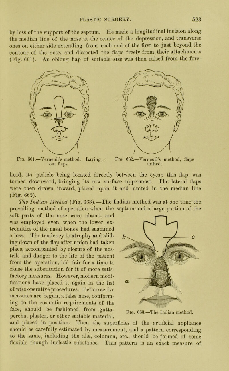 by loss of the support of the septum. He made a longitudinal incision along the median line of the nose at the center of the depression, and transverse ones on either side extending from each end of the first to just beyond the contour of the nose, and dissected the flaps freely from their attachments (Fig. 601). An oblong flap of suitable size was then raised from the fore- Fig. 661.—VerneuiFs method. Laying out flaps. Fig. 662.—Verneuil's method, flaps united. head, its pedicle being located directly between the eyes; this flap was turned downward, bringing its raw surface uppermost. The lateral flaps were then drawn inward, placed upon it and united in the median line (Fig. 662). The Indian Method (Fig. 663).—The Indian method was at one time the prevailing method of operation when the septum and a large portion of the soft parts of the nose were absent, and was employed even when the lower ex- tremities of the nasal bones had sustained a loss. The tendency to atrophy and slid- ing down of the flap after union had taken place, accompanied by closure of the nos- trils and danger to the life of the patient from the operation, bid fair for a time to cause the substitution for it of more satis- factory measures. However, modern modi- fications have placed it again in the list of wise operative procedures. Before active measures are begun, a false nose, conform- ing to the cosmetic requirements of the face, should be fashioned from gutta- percha, plaster, or other suitable material, and placed in position. Then the superficies of the artificial appliance should be carefully estimated by measurement, and a pattern corresponding to the same, including the alae, columna, etc., should be formed of some flexible though inelastic substance. This pattern is an exact measure of Fig. 663.—The Indian method.