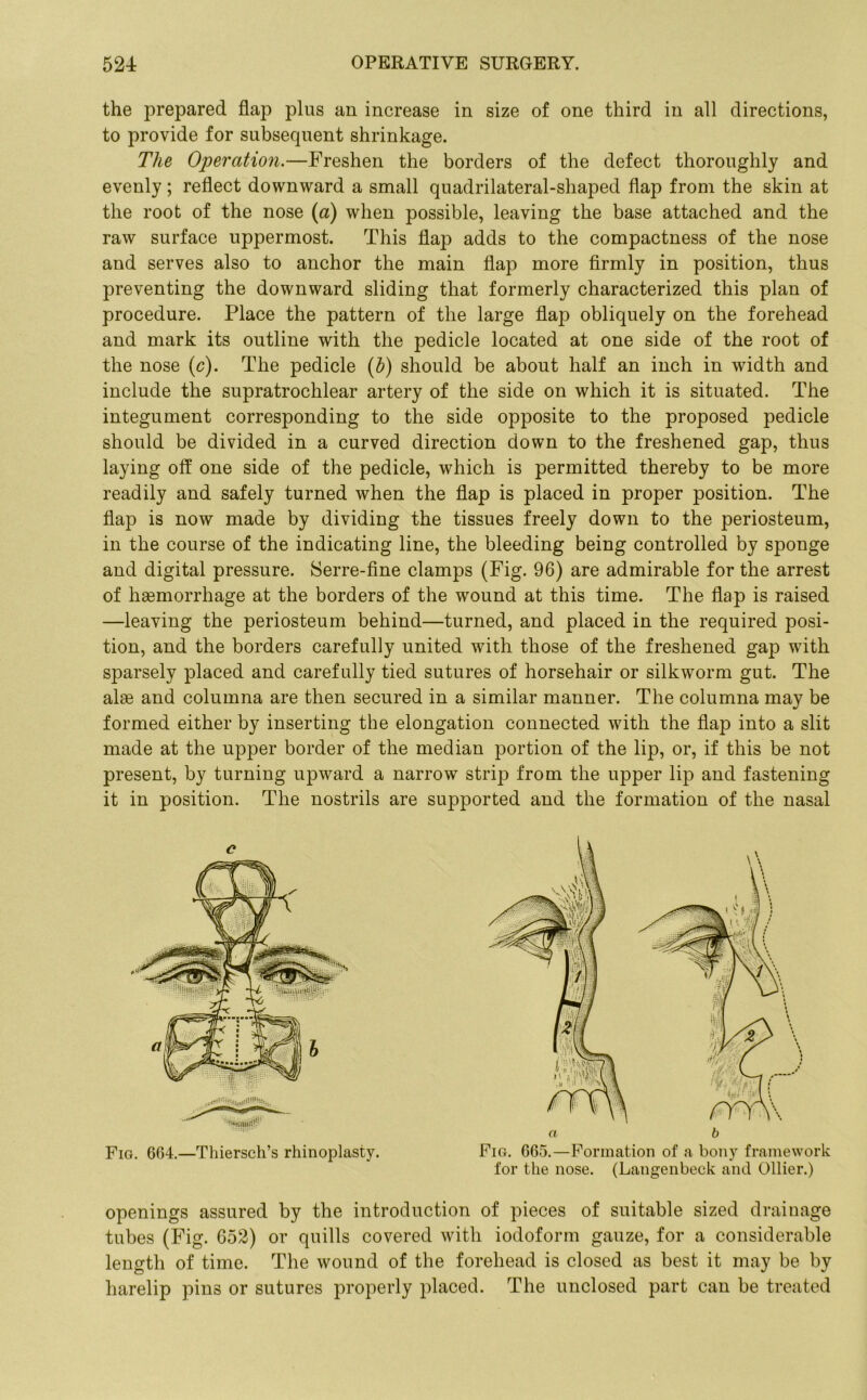 the prepared flap plus an increase in size of one third in all directions, to provide for subsequent shrinkage. The Operation.—Freshen the borders of the defect thoroughly and evenly; reflect downward a small quadrilateral-shaped flap from the skin at the root of the nose (a) when possible, leaving the base attached and the raw surface uppermost. This flap adds to the compactness of the nose and serves also to anchor the main flap more firmly in position, thus preventing the downward sliding that formerly characterized this plan of procedure. Place the pattern of the large flap obliquely on the forehead and mark its outline with the pedicle located at one side of the root of the nose (c). The pedicle (b) should be about half an inch in width and include the supratrochlear artery of the side on which it is situated. The integument corresponding to the side opposite to the proposed pedicle should be divided in a curved direction down to the freshened gap, thus laying off one side of the pedicle, which is permitted thereby to be more readily and safely turned when the flap is placed in proper position. The flap is now made by dividing the tissues freely down to the periosteum, in the course of the indicating line, the bleeding being controlled by sponge and digital pressure. Serre-fine clamps (Fig. 96) are admirable for the arrest of haemorrhage at the borders of the wound at this time. The flap is raised —leaving the periosteum behind—turned, and placed in the required posi- tion, and the borders carefully united with those of the freshened gap with sparsely placed and carefully tied sutures of horsehair or silkworm gut. The alas and columna are then secured in a similar manner. The columna may be formed either by inserting the elongation connected with the flap into a slit made at the upper border of the median portion of the lip, or, if this be not present, by turning upward a narrow strip from the upper lip and fastening it in position. The nostrils are supported and the formation of the nasal c Fig. 664.—Thiersch’s rhinoplasty. a b Fig. 665.—Formation of a bony framework for the nose. (Langenbeck and Ollier.) openings assured by the introduction of pieces of suitable sized drainage tubes (Fig. 652) or quills covered with iodoform gauze, for a considerable length of time. The wound of the forehead is closed as best it may be by harelip pins or sutures properly placed. The unclosed part can be treated