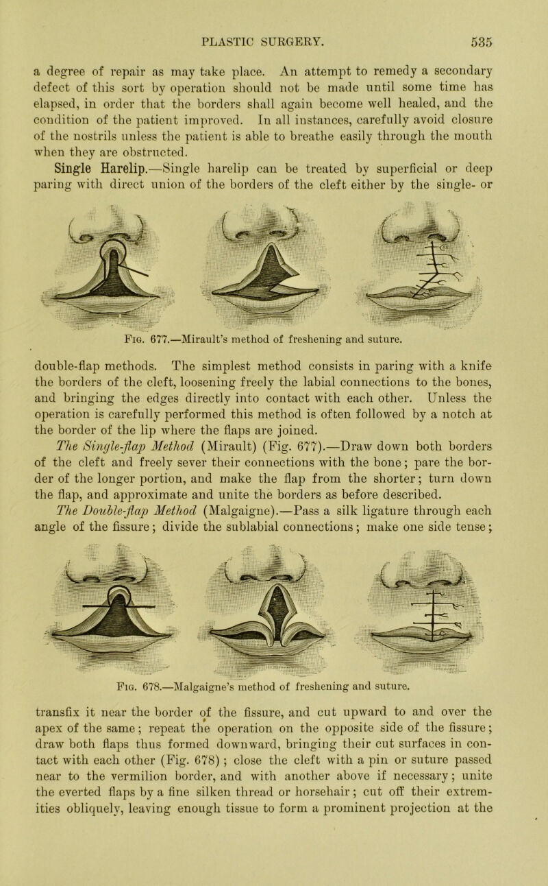 a degree of repair as may take place. An attempt to remedy a secondary defect of this sort by operation should not be made until some time has elapsed, in order that the borders shall again become well healed, and the condition of the patient improved. In all instances, carefully avoid closure of the nostrils unless the patient is able to breathe easily through the mouth when they are obstructed. Single Harelip.—Single harelip can be treated by superficial or deep paring with direct union of the borders of the cleft either by the single- or Fig. 677.—Mirault’s method of freshening and suture. double-flap methods. The simplest method consists in paring with a knife the borders of the cleft, loosening freely the labial connections to the bones, and bringing the edges directly into contact with each other. Unless the operation is carefully performed this method is often followed by a notch at the border of the lip where the flaps are joined. The Single-flap Method (Mirault) (Fig. 677).—Draw down both borders of the cleft and freely sever their connections with the bone; pare the bor- der of the longer portion, and make the flap from the shorter; turn down the flap, and approximate and unite the borders as before described. The DouUe-flaj) Method (Malgaigne).—Pass a silk ligature through each angle of the fissure; divide the sublabial connections; make one side tense; Fig. 678.—Malgaigne’s method of freshening and suture. transfix it near the border of the fissure, and cut upward to and over the apex of the same; repeat the operation on the opposite side of the fissure; draw both flaps thus formed downward, bringing their cut surfaces in con- tact with each other (Fig. 678) ; close the cleft with a pin or suture passed near to the vermilion border, and with another above if necessary; unite the everted flaps by a fine silken thread or horsehair; cut off their extrem- ities obliquely, leaving enough tissue to form a prominent projection at the