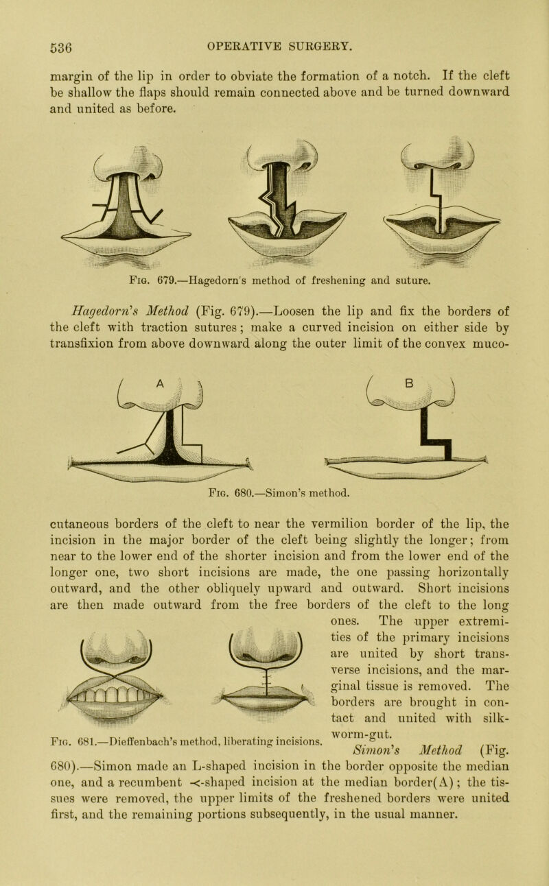 margin of the lip in order to obviate the formation of a notch. If the cleft be shallow the flaps should remain connected above and be turned downward and united as before. Fig. 679.—Hagedorn's method of freshening and suture. Hagedorn's Method (Fig. 679).—Loosen the lip and fix the borders of the cleft with traction sutures ; make a curved incision on either side by transfixion from above downward along the outer limit of the convex muco- Fig. 680.—Simon’s method. cutaneous borders of the cleft to near the vermilion border of the lip, the incision in the major border of the cleft being slightly the longer; from near to the lower end of the shorter incision and from the lower end of the longer one, two short incisions are made, the one passing horizontally outward, and the other obliquely upward and outward. Short incisions are then made outward from the free borders of the cleft to the long ones. The upper extremi- ties of the primary incisions are united by short trans- verse incisions, and the mar- ginal tissue is removed. The borders are brought in con- tact and united with silk- Fig. 681.—Dieffenbach’s method, liberating incisions. W01^ Simons Method (big. 680).—Simon made an L-shaped incision in the border opposite the median one, and a recumbent -<-shaped incision at the median border(A); the tis- sues were removed, the upper limits of the freshened borders were united first, and the remaining portions subsequently, in the usual manner.