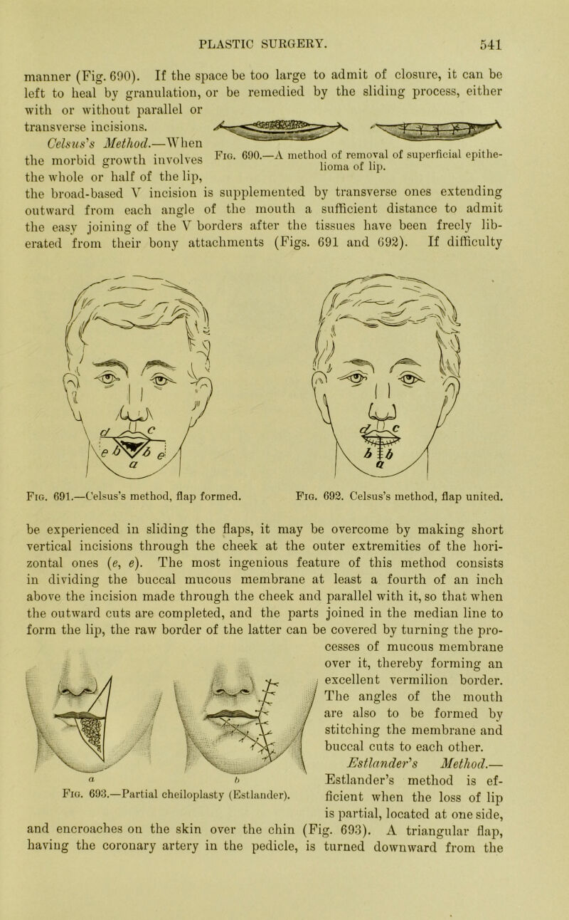 manner (Fig. 690). If the space be too large to admit of closure, it can be left to heal by granulation, or be remedied by the sliding process, either with or without parallel or transverse incisions. Celsus^s Method.—AY ben the morbid growth involves Fig- C90--A metho;J^ar„n™1 of superfioial ePithe‘ the whole or half of the lip, the broad-based V incision is supplemented by transverse ones extending outward from each angle of the mouth a sufficient distance to admit the easy joining of the V borders after the tissues have been freely lib- erated from their bony attachments (Figs. 691 and 692). If difficulty Fig. 691.—Celsus’s method, flap formed. Fig. 692. Celsus’s method, flap united. be experienced in sliding the flaps, it may be overcome by making short vertical incisions through the cheek at the outer extremities of the hori- zontal ones (e, e). The most ingenious feature of this method consists in dividing the buccal mucous membrane at least a fourth of an inch above the incision made through the cheek and parallel with it, so that when the outward cuts are completed, and the parts joined in the median line to form the lip, the raw border of the latter can be covered by turning the pro- cesses of mucous membrane over it, thereby forming an excellent vermilion border. The angles of the mouth are also to be formed by stitching the membrane and buccal cuts to each other. Estlander's Method.— Estlander’s method is ef- ficient when the loss of lip is partial, located at one side, and encroaches on the skin over the chin (Fig. 693). A triangular flap, having the coronary artery in the pedicle, is turned downward from the Fig. 693.—Partial cheiloplasty (Estlander).