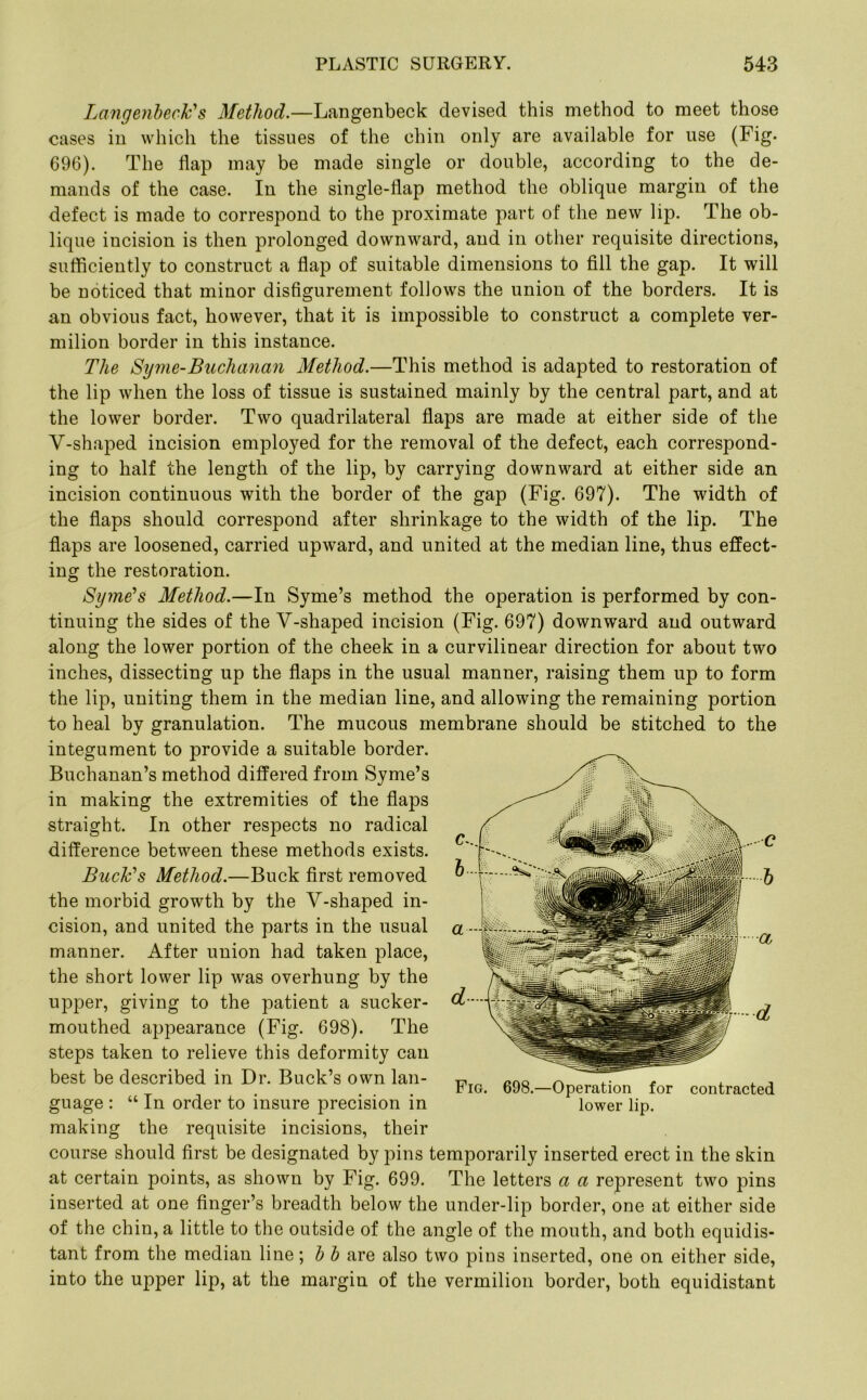 Langenbeck's Method.—Langenbeck devised this method to meet those cases in which the tissues of the chin only are available for use (Fig. 696). The flap may be made single or double, according to the de- mands of the case. In the single-flap method the oblique margin of the defect is made to correspond to the proximate part of the new lip. The ob- lique incision is then prolonged downward, and in other requisite directions, sufficiently to construct a flap of suitable dimensions to fill the gap. It will be noticed that minor disfigurement follows the union of the borders. It is an obvious fact, however, that it is impossible to construct a complete ver- milion border in this instance. The Syme-Buchanan Method.—This method is adapted to restoration of the lip when the loss of tissue is sustained mainly by the central part, and at the lower border. Two quadrilateral flaps are made at either side of the Y-shaped incision employed for the removal of the defect, each correspond- ing to half the length of the lip, by carrying downward at either side an incision continuous with the border of the gap (Fig. 697). The width of the flaps should correspond after shrinkage to the width of the lip. The flaps are loosened, carried upward, and united at the median line, thus effect- ing the restoration. Syme's Method.—In Syme’s method the operation is performed by con- tinuing the sides of the V-shaped incision (Fig. 697) downward and outward along the lower portion of the cheek in a curvilinear direction for about two inches, dissecting up the flaps in the usual manner, raising them up to form the lip, uniting them in the median line, and allowing the remaining portion to heal by granulation. The mucous membrane should be stitched to the integument to provide a suitable border. Buchanan’s method differed from Syme’s in making the extremities of the flaps straight. In other respects no radical difference between these methods exists. Buck's Method.—Buck first removed the morbid growth by the Y-shaped in- cision, and united the parts in the usual manner. After union had taken place, the short lower lip was overhung by the upper, giving to the patient a sucker- mouthed appearance (Fig. 698). The steps taken to relieve this deformity can best be described in Dr. Buck’s own lan- guage : “ In order to insure precision in making the requisite incisions, their course should first be designated by pins temporarily inserted erect in the skin at certain points, as shown by Fig. 699. The letters a a represent two pins inserted at one finger’s breadth below the under-lip border, one at either side of the chin, a little to the outside of the angle of the mouth, and both equidis- tant from the median line; b b are also two pins inserted, one on either side, into the upper lip, at the margin of the vermilion border, both equidistant Fig. 698.—Operation for contracted lower lip.