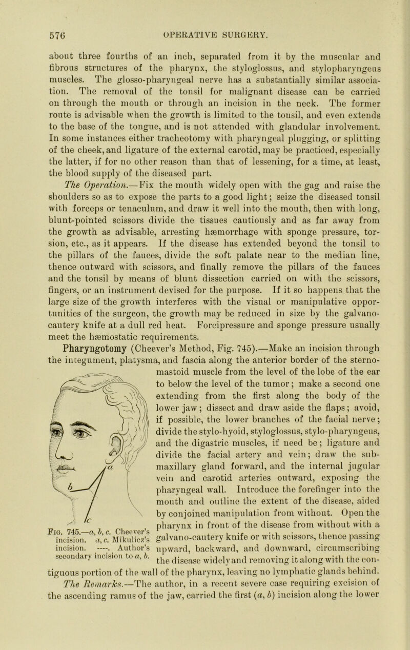about three fourths of an inch, separated from it by the muscular and fibrous structures of the pharynx, the styloglossus, and stylopharyngeus muscles. The glosso-pharyngeal nerve has a substantially similar associa- tion. The removal of the tonsil for malignant disease can be carried on through the mouth or through an incision in the neck. The former route is advisable when the growth is limited to the tonsil, and even extends to the base of the tongue, and is not attended with glandular involvement. In some instances either tracheotomy with pharyngeal plugging, or splitting of the cheek, and ligature of the external carotid, may be practiced, especially the latter, if for no other reason than that of lessening, for a time, at least, the blood supply of the diseased part. The Operation.—Fix the mouth widely open with the gag and raise the shoulders so as to expose the parts to a good light; seize the diseased tonsil with forceps or tenaculum, and draw it well into the mouth, then with long, blunt-pointed scissors divide the tissues cautiously and as far away from the growth as advisable, arresting haemorrhage with sponge pressure, tor- sion, etc., as it appears. If the disease has extended beyond the tonsil to the pillars of the fauces, divide the soft palate near to the median line, thence outward with scissors, and finally remove the pillars of the fauces and the tonsil by means of blunt dissection carried on with the scissors, fingers, or an instrument devised for the purpose. If it so happens that the large size of the growth interferes with the visual or manipulative oppor- tunities of the surgeon, the growth may be reduced in size by the galvano- cautery knife at a dull red heat. Forcipressure and sponge pressure usually meet the haemostatic requirements. Pharyngotomy (Cheever’s Method, Fig. 745).—Make an incision through the integument, platysma, and fascia along the anterior border of the sterno- mastoid muscle from the level of the lobe of the ear to below the level of the tumor; make a second one extending from the first along the body of the lower jaw; dissect and draw aside the flaps; avoid, if possible, the lower branches of the facial nerve; divide the stylo-hyoid, styloglossus, stylo-pharyngeus, and the digastric muscles, if need be; ligature and divide the facial artery and vein; draw the sub- maxillary gland forward, and the internal jugular vein and carotid arteries outward, exposing the pharyngeal wall. Introduce the forefinger into the mouth and outline the extent of the disease, aided by conjoined manipulation from without. Open the pharynx in front of the disease from without with a galvano-cautery knife or with scissors, thence passing —Author’s upward, backward, and downward, circumscribing secondary incision to a, h. disease widely and removing it along with the con- tiguous portion of the wall of the pharynx, leaving no lymphatic glands behind. The Remarhfi.—T\\Q author, in a recent severe case requiring excision of the ascending ramus of the jaw, carried the first («, h) incision along the lower Fig. 745.—a, b, c. Cheever’s incision. a,c. Mikulicz’s incision.