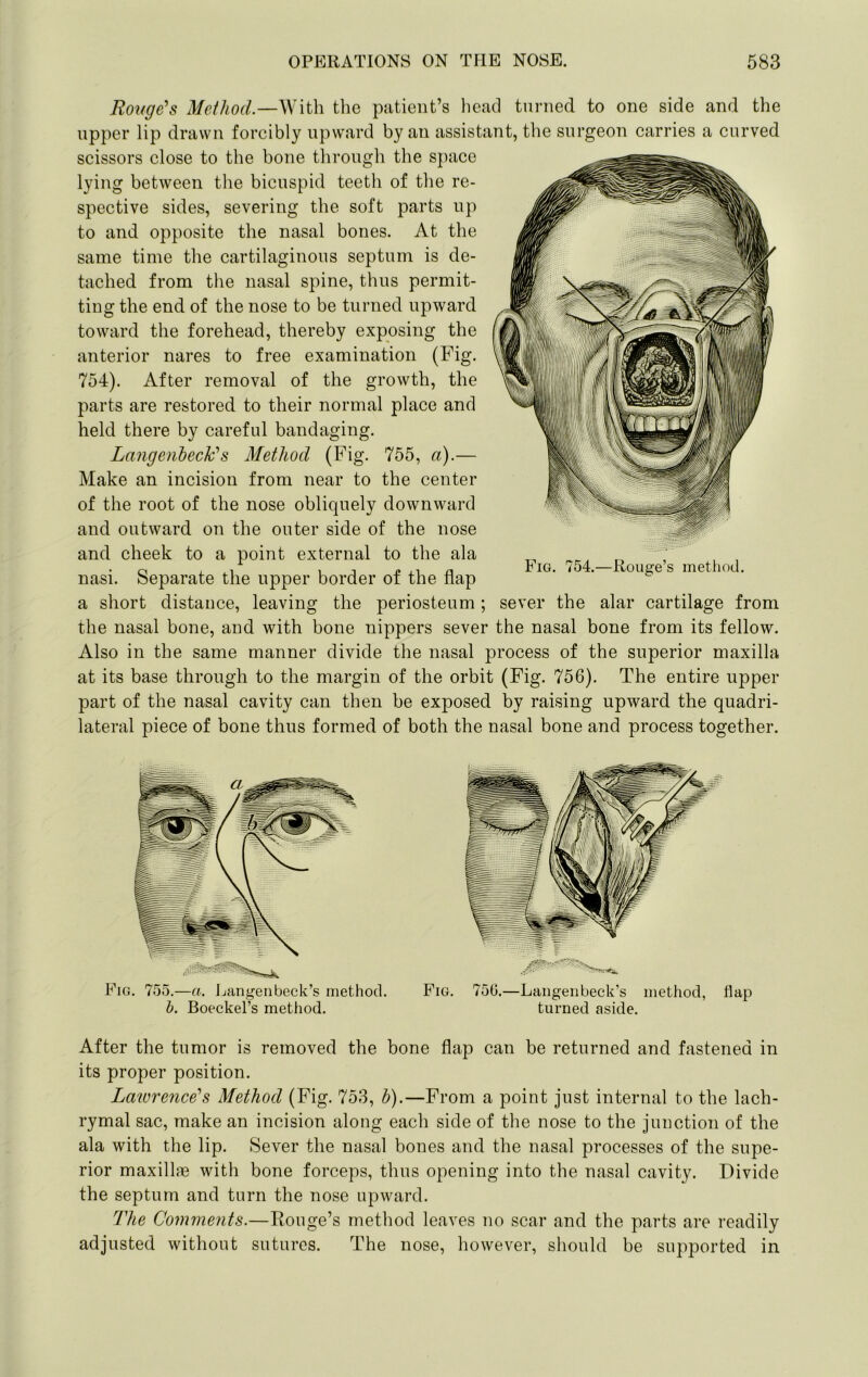 Rouge^s Method.—With the patient’s head turned to one side and the upper lip drawn forcibly upward by an assistant, the surgeon carries a curved scissors close to the bone through the space lying between the bicuspid teeth of the re- spective sides, severing the soft parts up to and opposite the nasal bones. At the same time the cartilaginous septum is de- tached from the nasal spine, thus permit- ting the end of the nose to be turned upward toward the forehead, thereby exposing the anterior nares to free examination (Fig. 754). After removal of the growth, the parts are restored to their normal place and held there by careful bandaging. Langenbeck’’s Method (Fig. 755, a).— Make an incision from near to the center of the root of the nose obliquely downward and outward on the outer side of the nose and cheek to a point external to the ala nasi. Separate the upper border of the flap a short distance, leaving the periosteum; sever the alar cartilage from the nasal bone, and with bone nippers sever the nasal bone from its fellow. Also in the same manner divide the nasal process of the superior maxilla at its base through to the margin of the orbit (Fig. 756). The entire upper part of the nasal cavity can then be exposed by raising upward the quadri- lateral piece of bone thus formed of both the nasal bone and process together. Fig. 754.—Rouge’s method. After the tumor is removed the bone flap can be returned and fastened in its proper position. Laiorence's Method (Fig. 753, b).—From a point just internal to the lach- rymal sac, make an incision along each side of the nose to the junction of the ala with the lip. Sever the nasal bones and the nasal processes of the supe- rior maxillae with bone forceps, thus opening into the nasal cavity. Divide the septum and turn the nose upward. The Comments.—Rouge’s method leaves no scar and the parts are readily adjusted without sutures. The nose, however, should be supported in