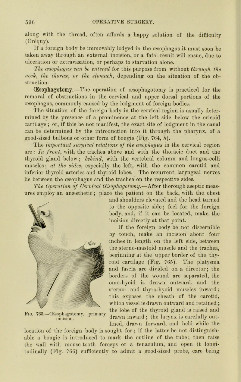 aloug with the thread, often affords a happy solution of the difficulty (Crequy). If a foreign body be immovably lodged in the oesophagus it must soon be taken away through an external incision, or a fatal result will ensue, due to ulceration or extravasation, or j^erhaps to starvation alone. The oesophagus can he entered for this purpose from without through the nech^ the thorax, or the stomach, depending on the situation of the ob- struction. (Esophagotomy.—The operation of oesophagotomy is practiced for the removal of obstructions in the cervical and upper dorsal portions of the oesophagus, commonly caused by the lodgment of foreign bodies. The situation of the foreign body in the cervical region is usually deter- mined by the presence of a prominence at the left side below the cricoid cartilage ; or, if this be not manifest, the exact site of lodgment in the canal can be determined by the introduction into it through the pharynx, of a good-sized bulbous or other form of bougie (Fig. 764, h). The important surgical relations of the oesophagus in the cervical region are: In front, with the trachea above and with the thoracic duct and the thyroid gland below; hehind, with the vertebral column and longus-colli muscles; at the sides, especially the left, with the common carotid and inferior thyroid arteries and thyroid lobes. The recurrent laryngeal nerves lie between the oesophagus and the trachea on the respective sides. The Operation of Cervical QIsophagoto7ny.—After thorough aseptic meas- ures employ an anaesthetic; place the patient on the back, with the. chest and shoulders elevated and the head turned to the opposite side; feel for the foreign body, and, if it can be located, make the incision directly at that point. If the foreign body be not discernible by touch, make an incision about four inches in length on the left side, between the sterno-mastoid muscle and the trachea, beginning at the upper border of the thy- roid cartilage (Fig. 765). The plat}sma and fascia are divided on a director; the borders of the wound are separated, the omo-hyoid is drawn outward, and the sterno- and thyro-hyoid muscles inward; this exposes the sheath of the carotid, which vessel is drawn outward and retained ; the lobe of the thyroid gland is raised and drawn inward ; the larynx is carefully out- lined, drawn forward, and held while the location of the foreign body is sought for ; if the latter be not distinguish- able a bougie is introduced to mark the outline of the tube; then raise the wall with mouse-tooth forceps or a tenaculum, and open it longi- tudinally (Fig. 766) sufficiently to admit a good-sized probe, care being Fig 765.—G^]sophagotomy, incision. primary