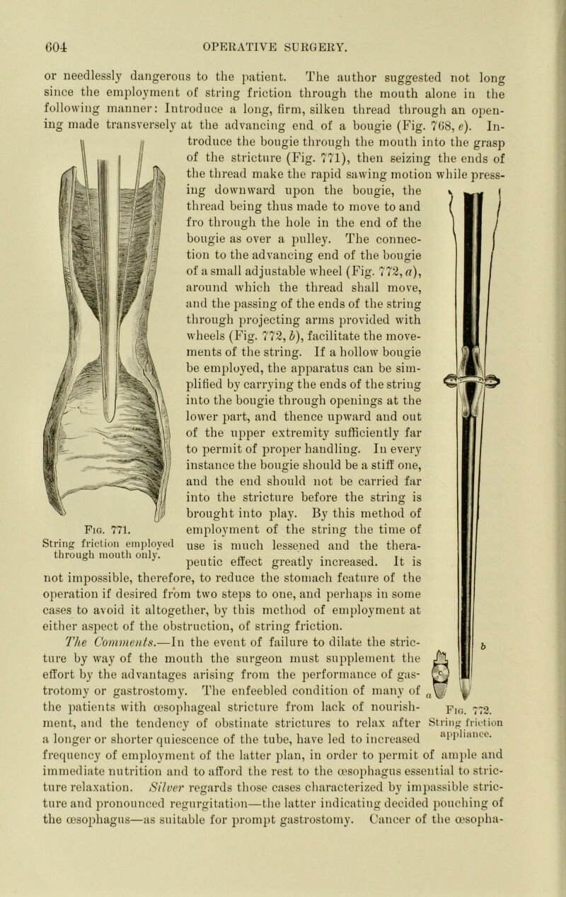 /) or needlessly dangerous to the patient. The author suggested not long since the employment of string friction through the mouth alone in the following manner: Introduce a long, firm, silken thread through an open- ing made transversely at the advancing end of a bougie (Fig. 768, e). In- troduce the bougie through the mouth into the grasp of the stricture (Fig. 771), then seizing the ends of the thread make the rapid sawing motion while press- ing downward upon the bougie, the thread being thus made to move to and fro through the hole in the end of the bougie as over a pulley. The connec- tion to the advancing end of the bougie of a small adjustable wheel (Fig. 772,«), around which the thread shall move, and the passing of the ends of the string through projecting arms provided with wheels (Fig. 772, ^), facilitate the move- ments of the string. If a hollow bougie be employed, the apparatus can be sim- plified by carrying the ends of the string into the bougie through openings at the lower part, and thence upw^ard and out of the upper extremity sufficiently far to permit of proper handling. In every instance the bougie should be a stiff one, and the end should not be carried far into the stricture before the string is brought into play. By this method of employment of the string the time of use is much lessened and the thera- peutic effect greatly increased. It is not impossible, therefore, to reduce the stomach feature of the operation if desired from two steps to one, and perhaps in some cases to avoid it altogether, by this method of employment at either aspect of the obstruction, of string friction. The Comments.—In the event of failure to dilate the stric- ture by way of the mouth the surgeon must supplement the effort by the advantages arising from the performance of gas- trotomy or gastrostomy. The enfeebled condition of many of the patients with oesophageal stricture from lack of nourish- ment, and the tendency of obstinate strictures to relax after a longer or shorter quiescence of the tube, have led to increased frequency of employment of the latter plan, in order to permit of ample and immediate nutrition and to afford the rest to the oesophagus essential to stric- ture relaxation. Silver regards those cases characterized by impassible stric- ture and pronounced regurgitation—the latter indicating decided pouching of the oesophagus—as suitable for prompt gastrostomy. Cancer of the msopha- Fig. 771. String friction employed through moiitli only. Fig. 772. String friction a[)])liancc.